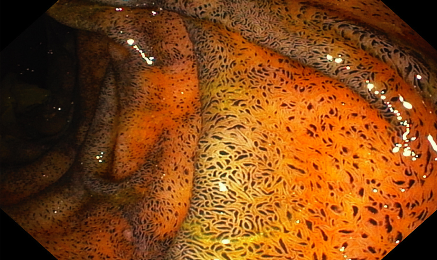 Pseudomelanosis duodeni