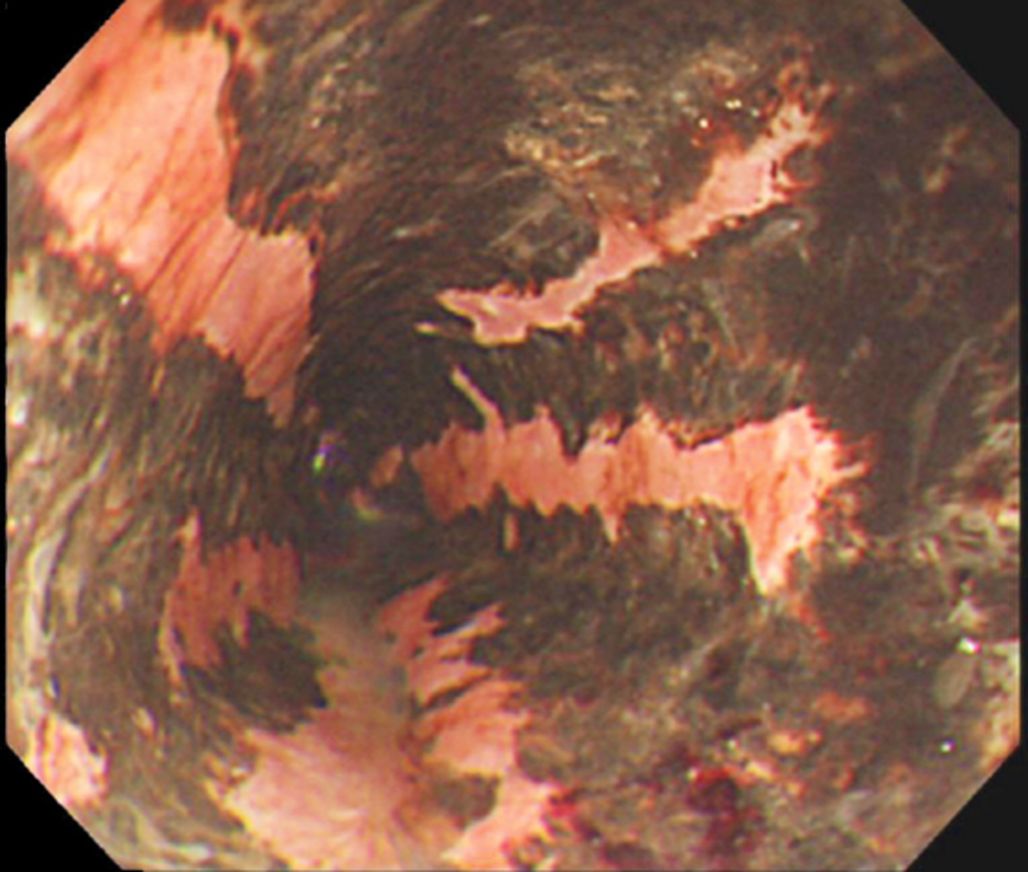 Acute esophageal necrosis