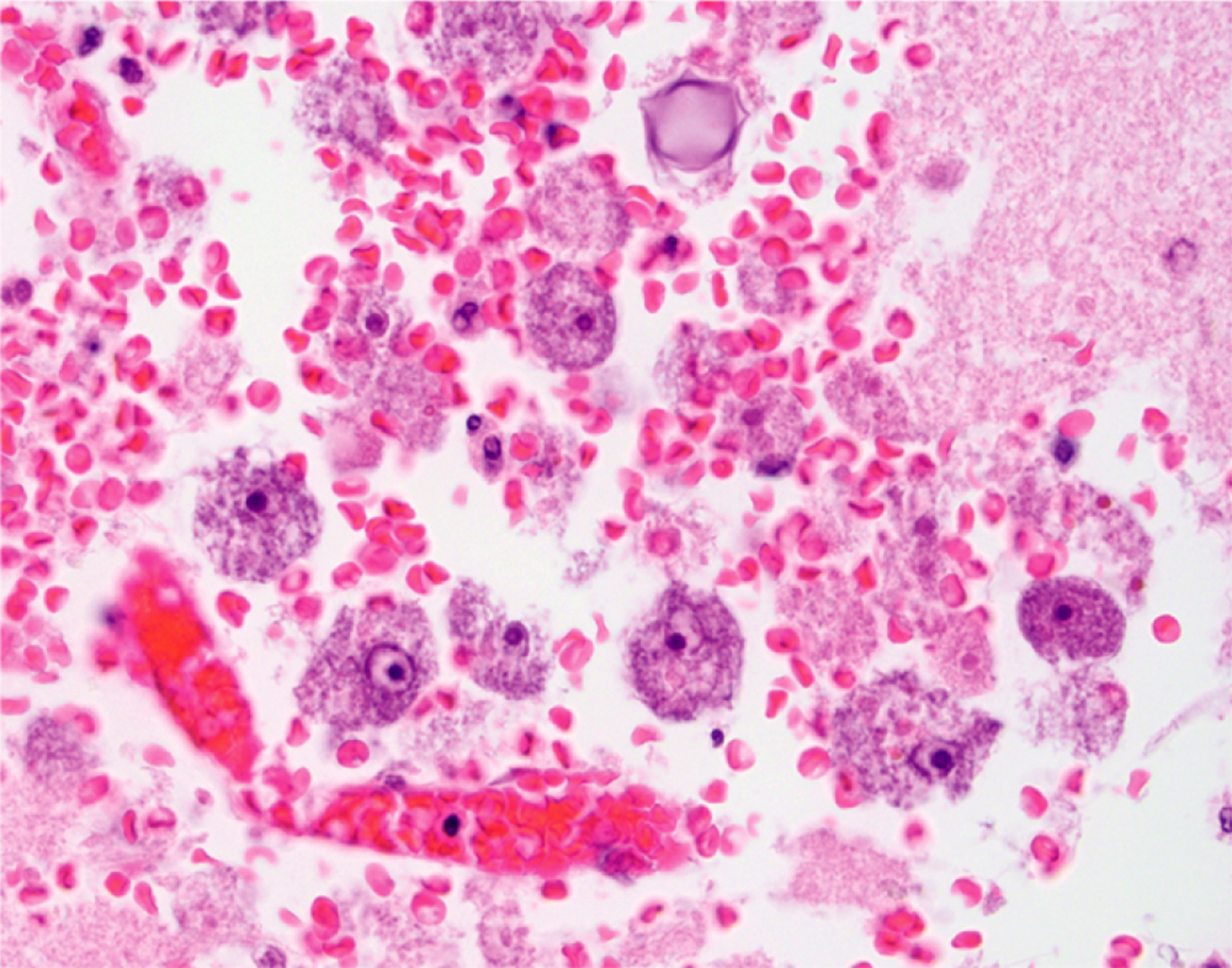 Granulomatous amebic encephalitis