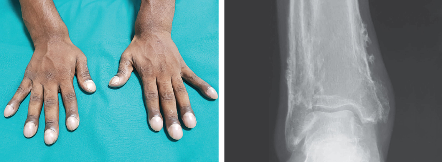 Primary hypertrophic osteoarthropathy