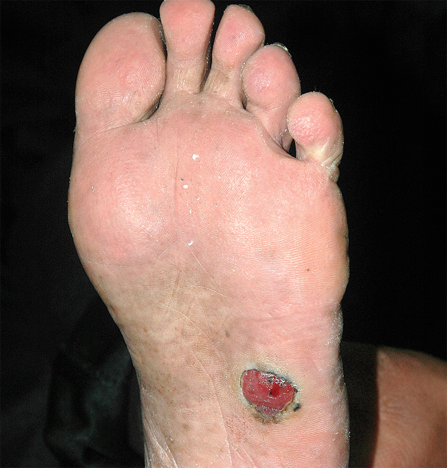 Amelanotic melanoma