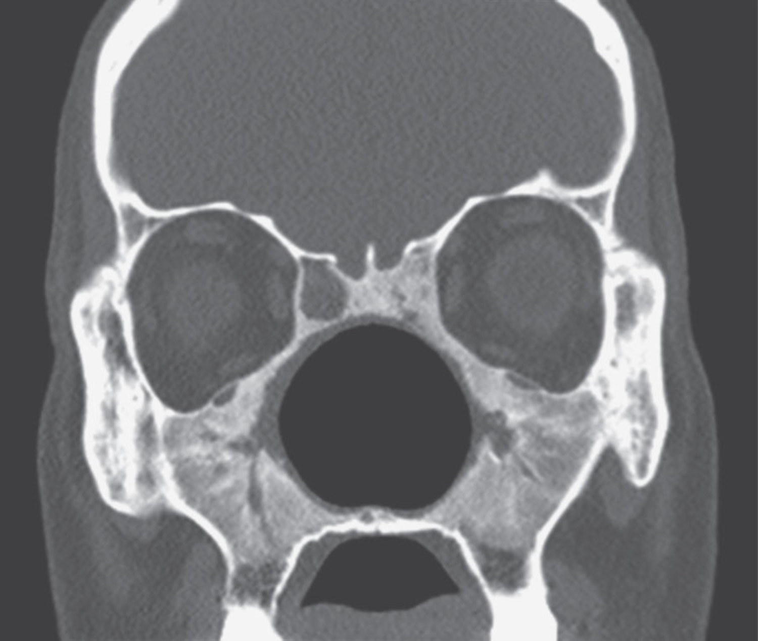 Granulomatosis with polyangiitis