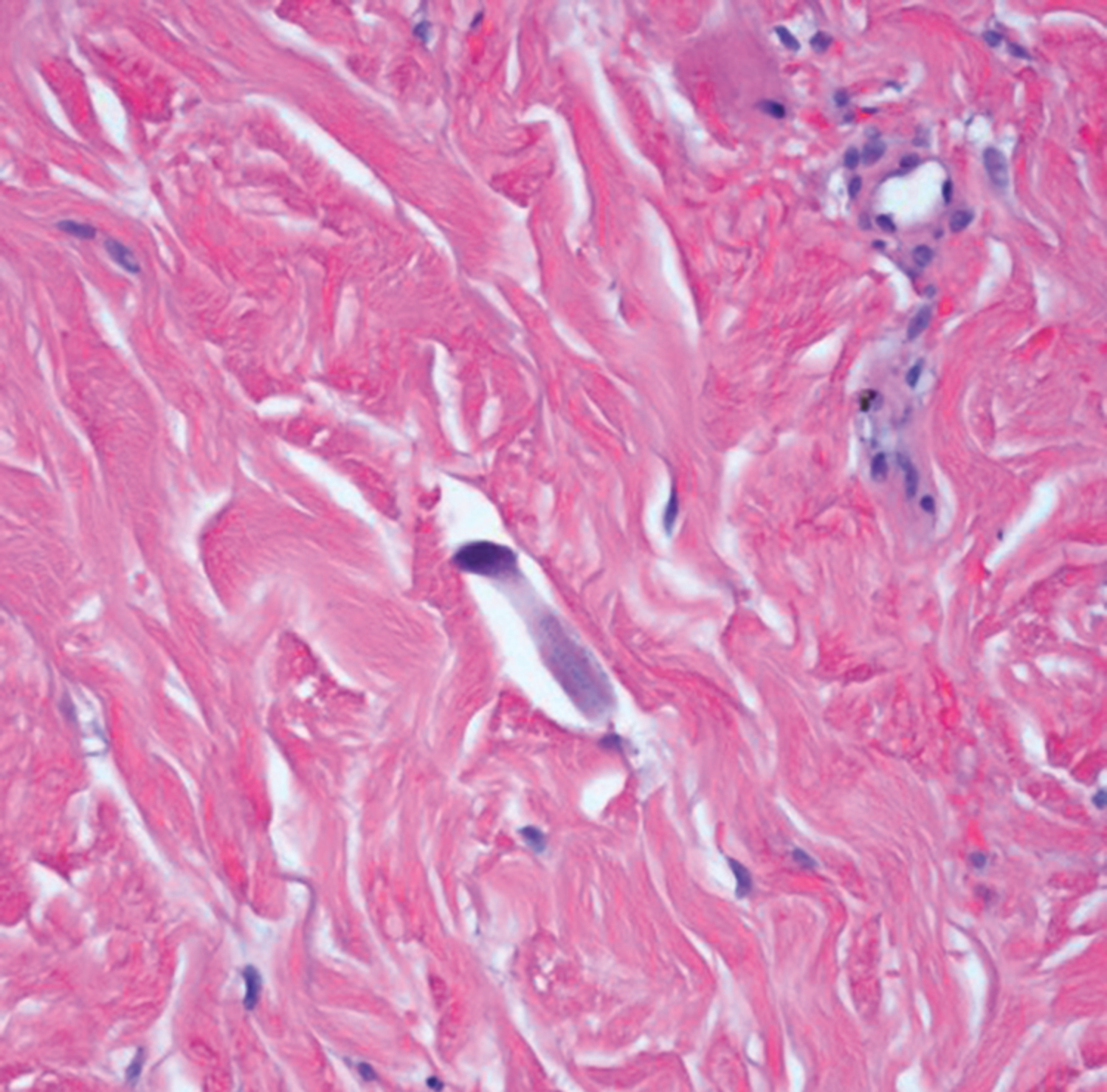 Strongyloides stercoralis