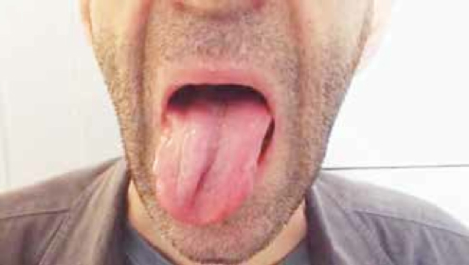 Hypoglossal nerve palsy