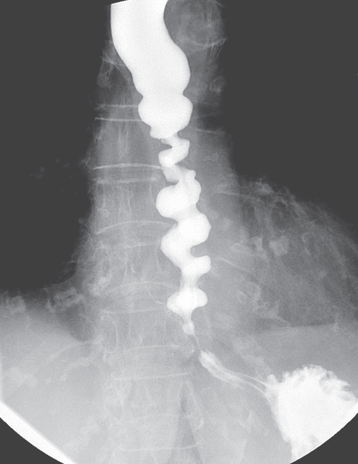 Achalasia