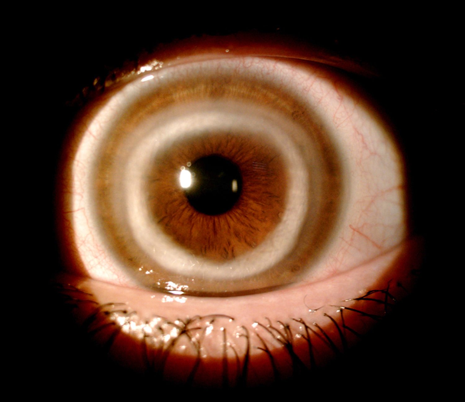 Cogan's syndrome