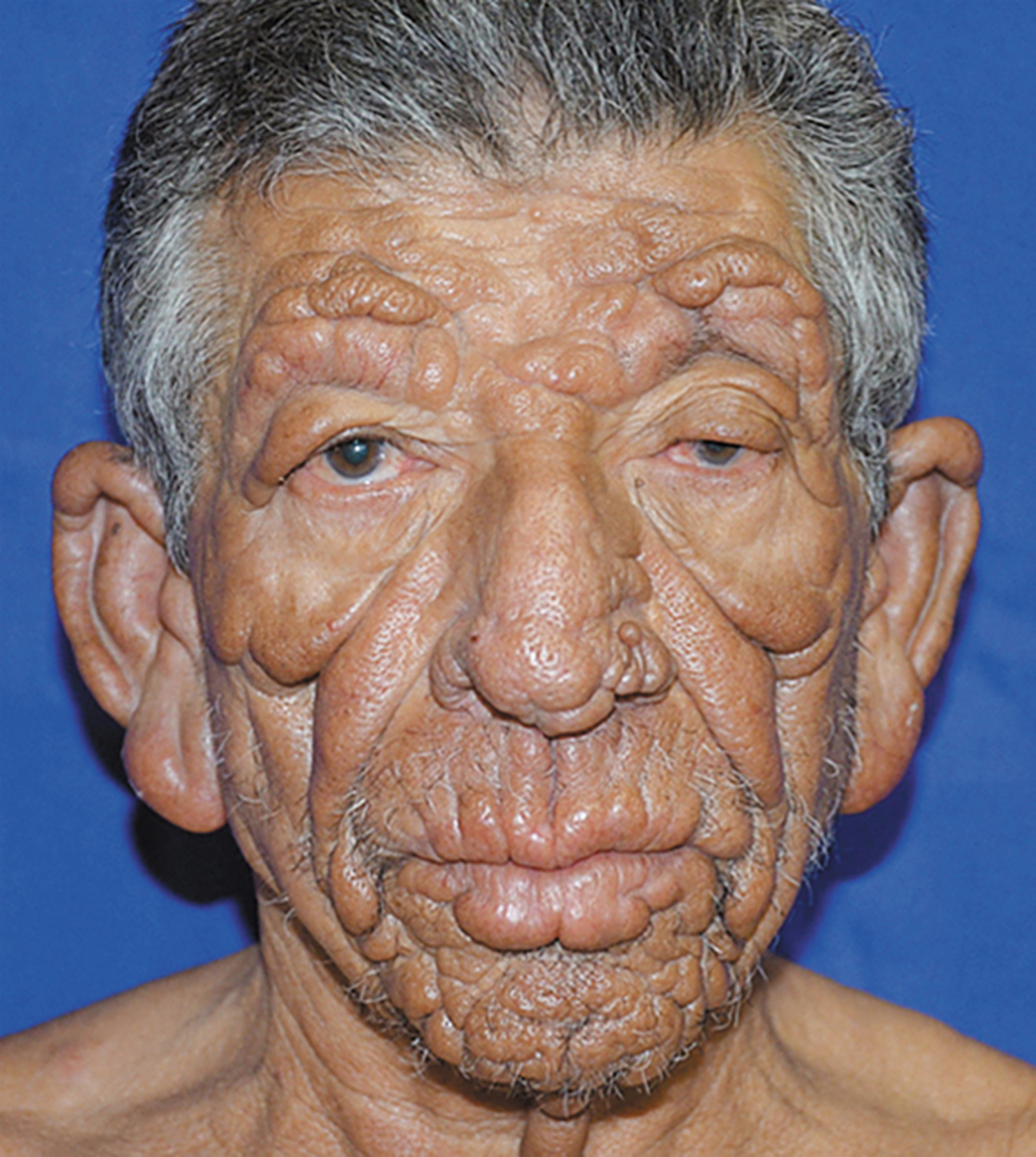 Lepromatous leprosy