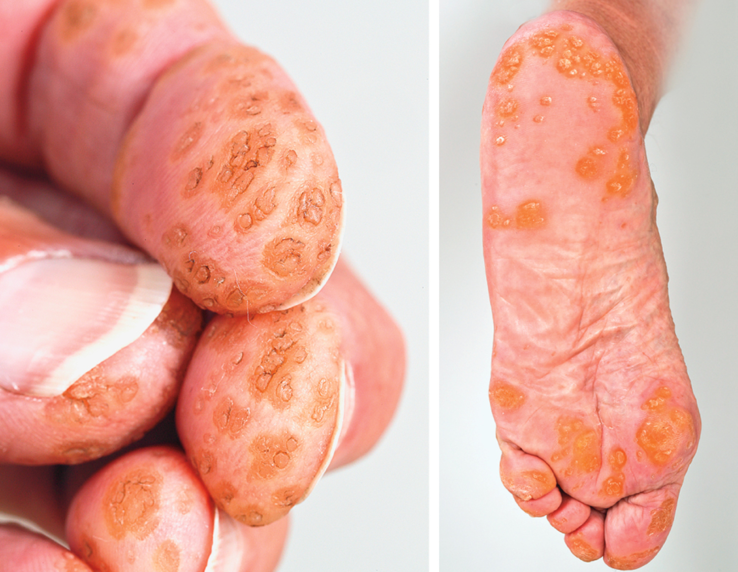 Punctate palmoplantar keratoderma