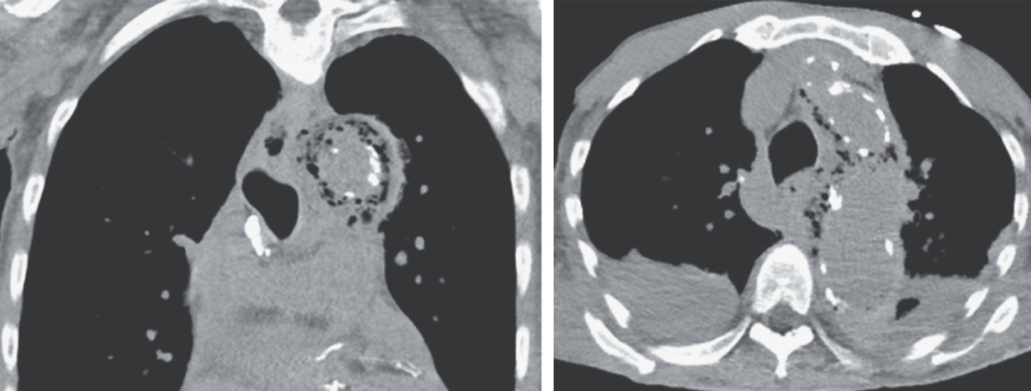 Emphysematous aortitis due to Clostridium septicum