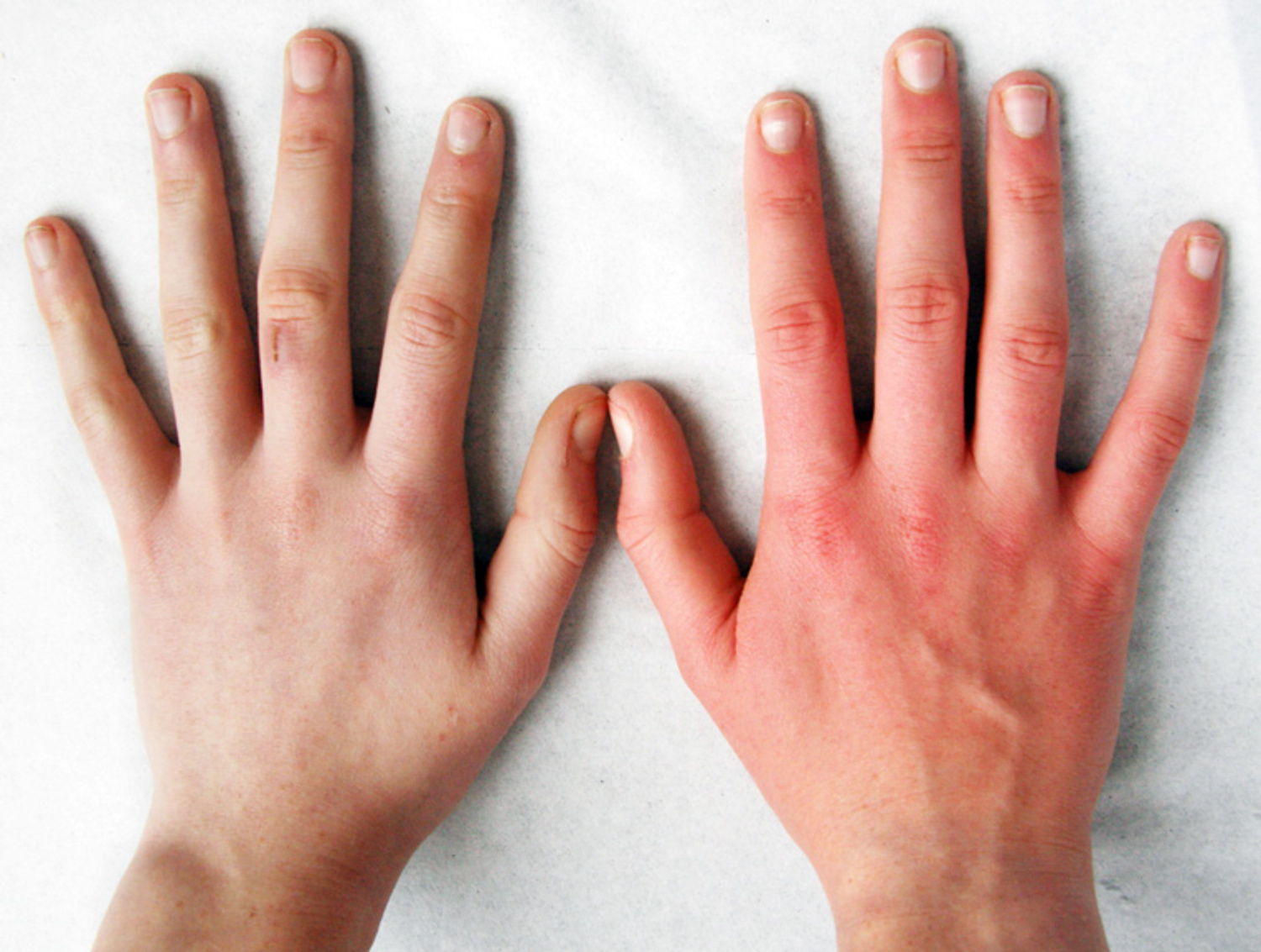 Erythromelalgia
