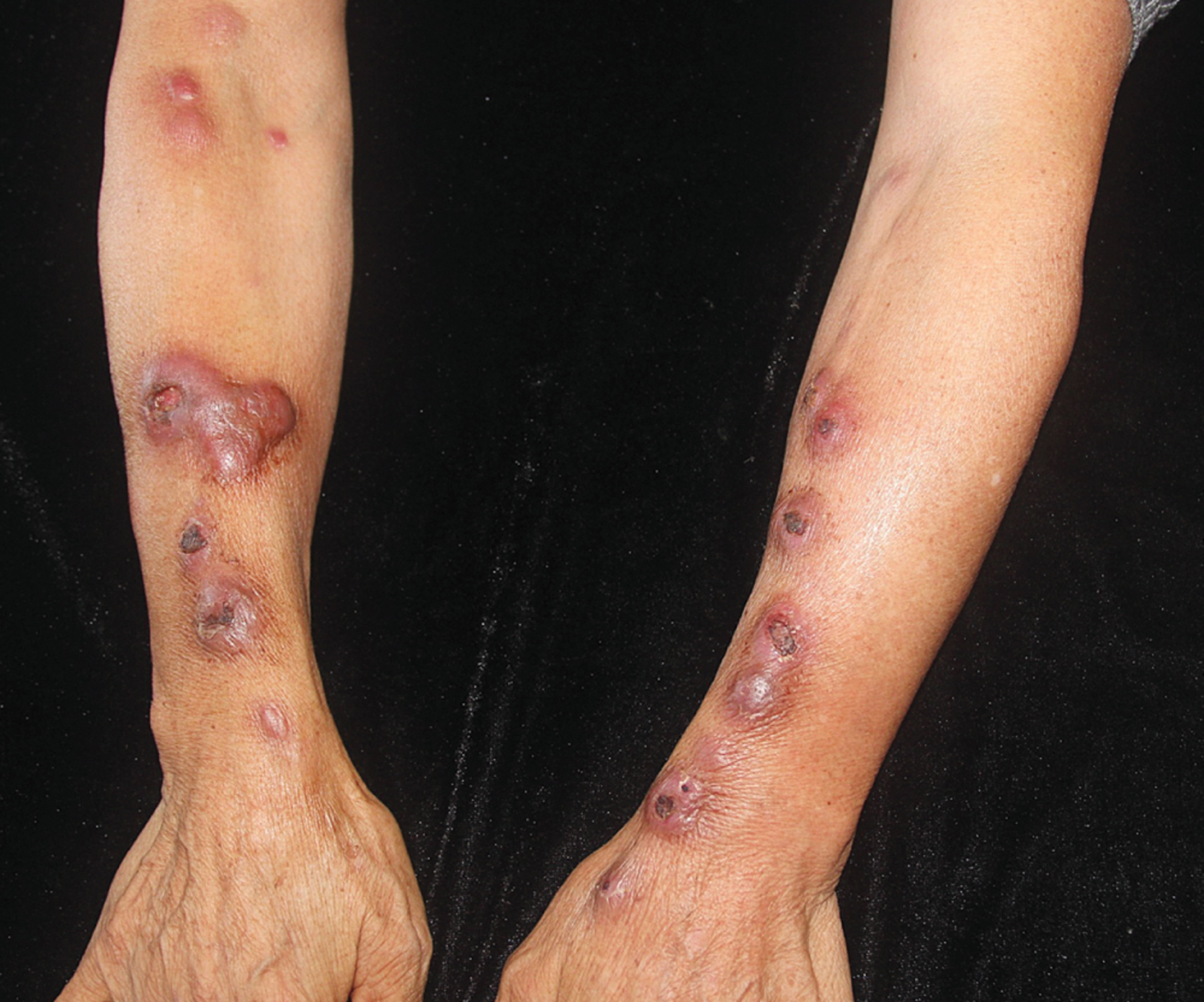 Mycobacterium marinum