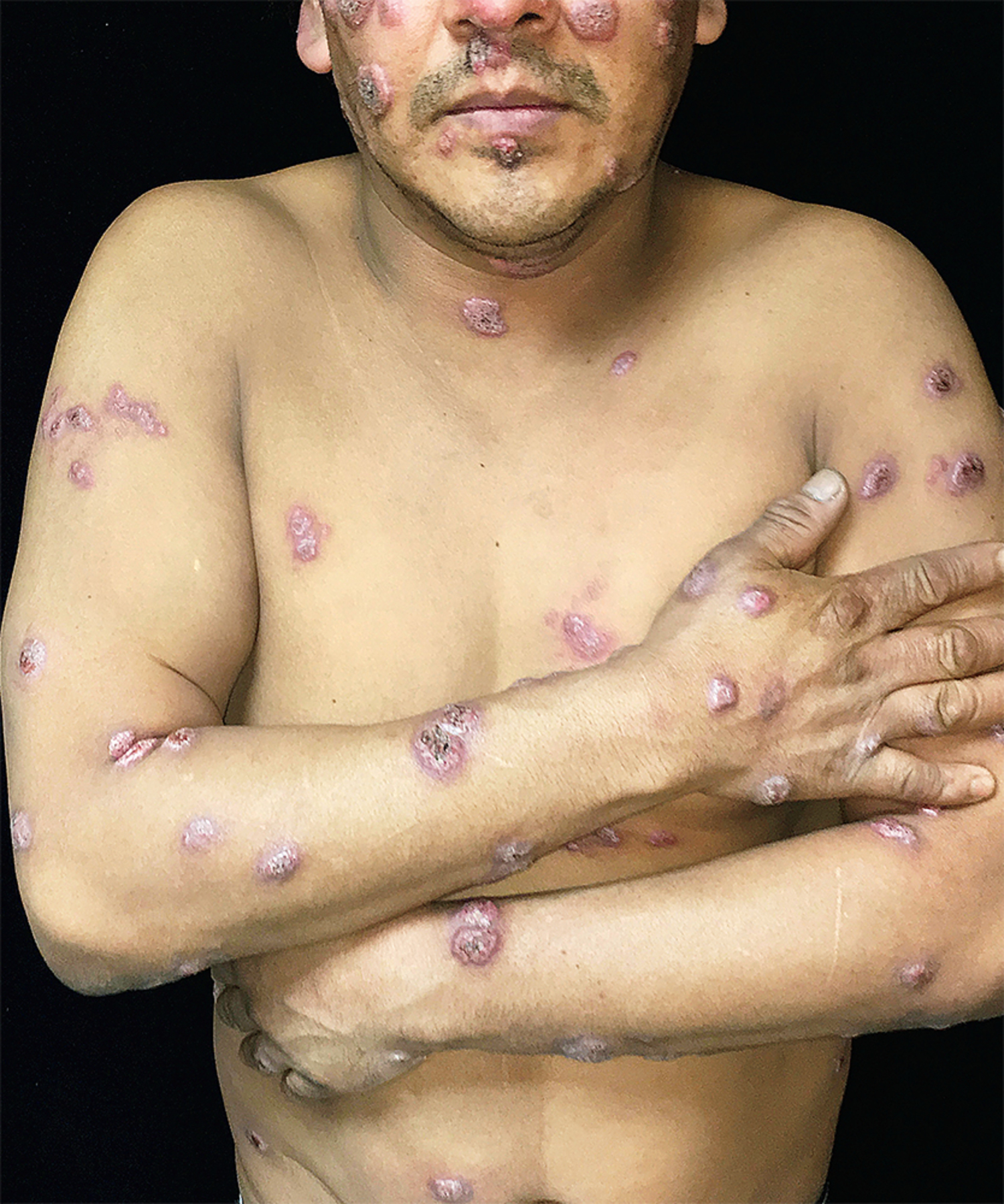 Disseminated cutaneous blastomycosis