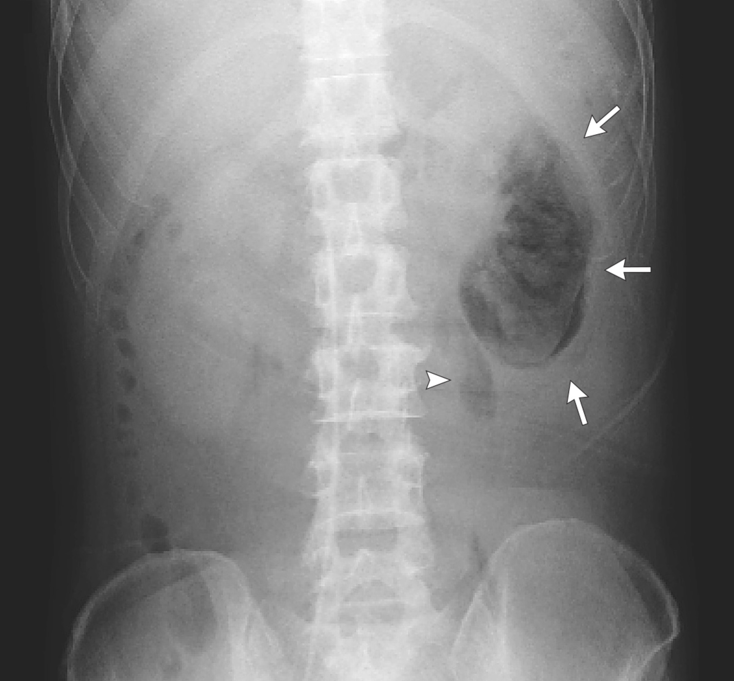 Emphysematous pyelonephritis