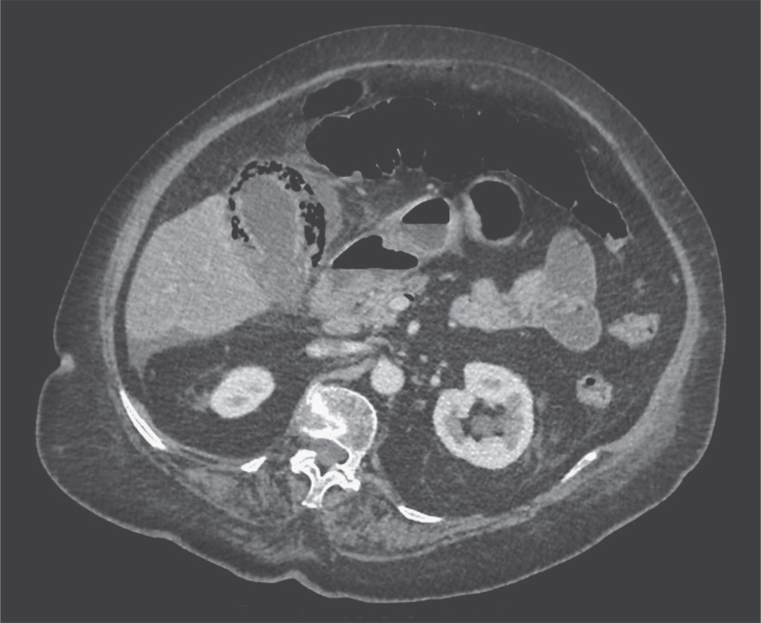 Emphysematous cholecystitis