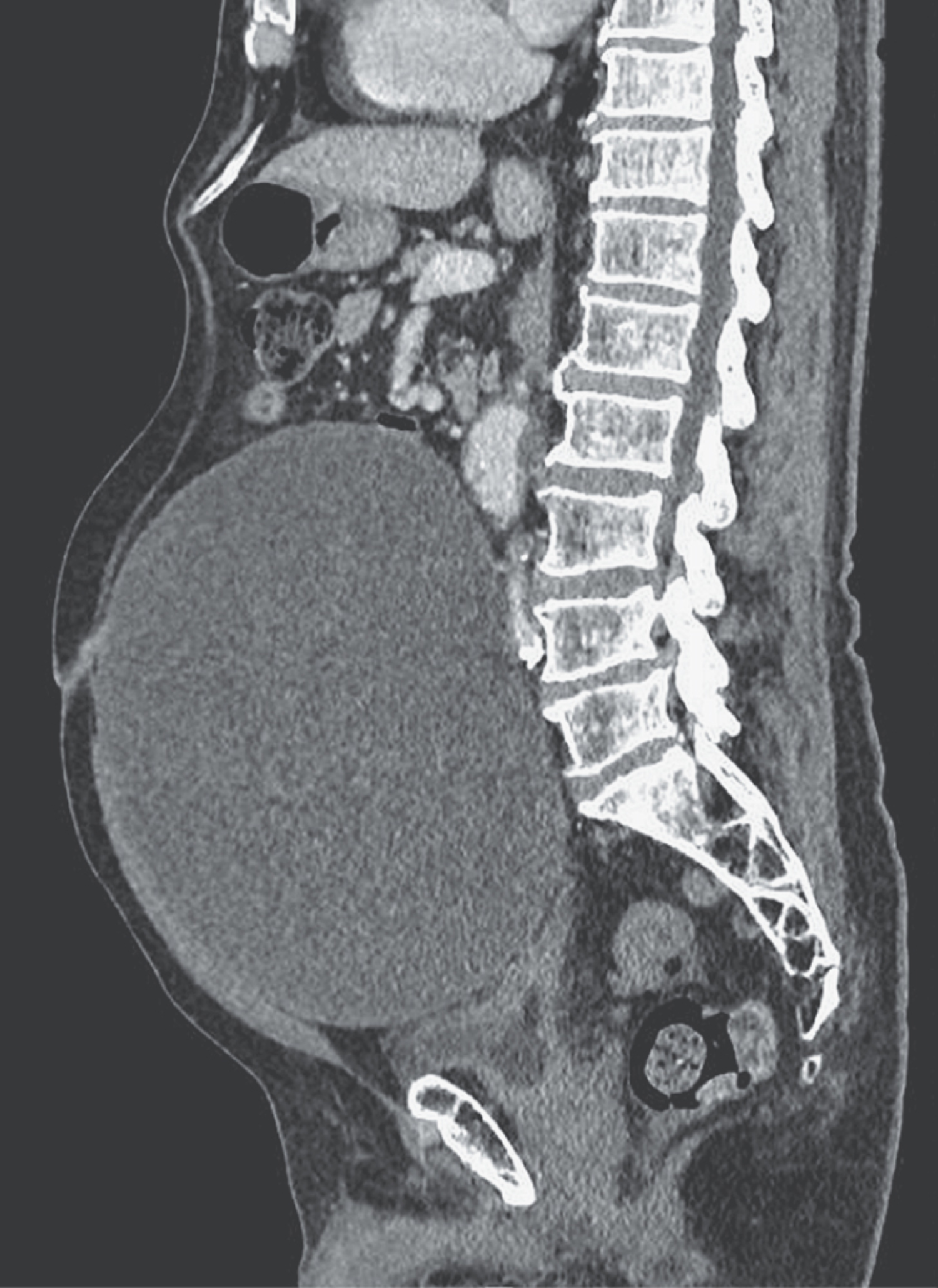 Urachal mucinous cystic tumor