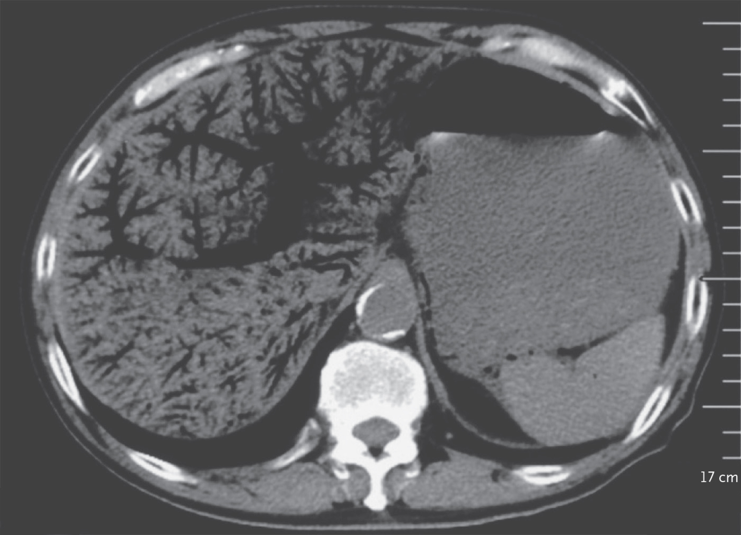Bowel ischemia