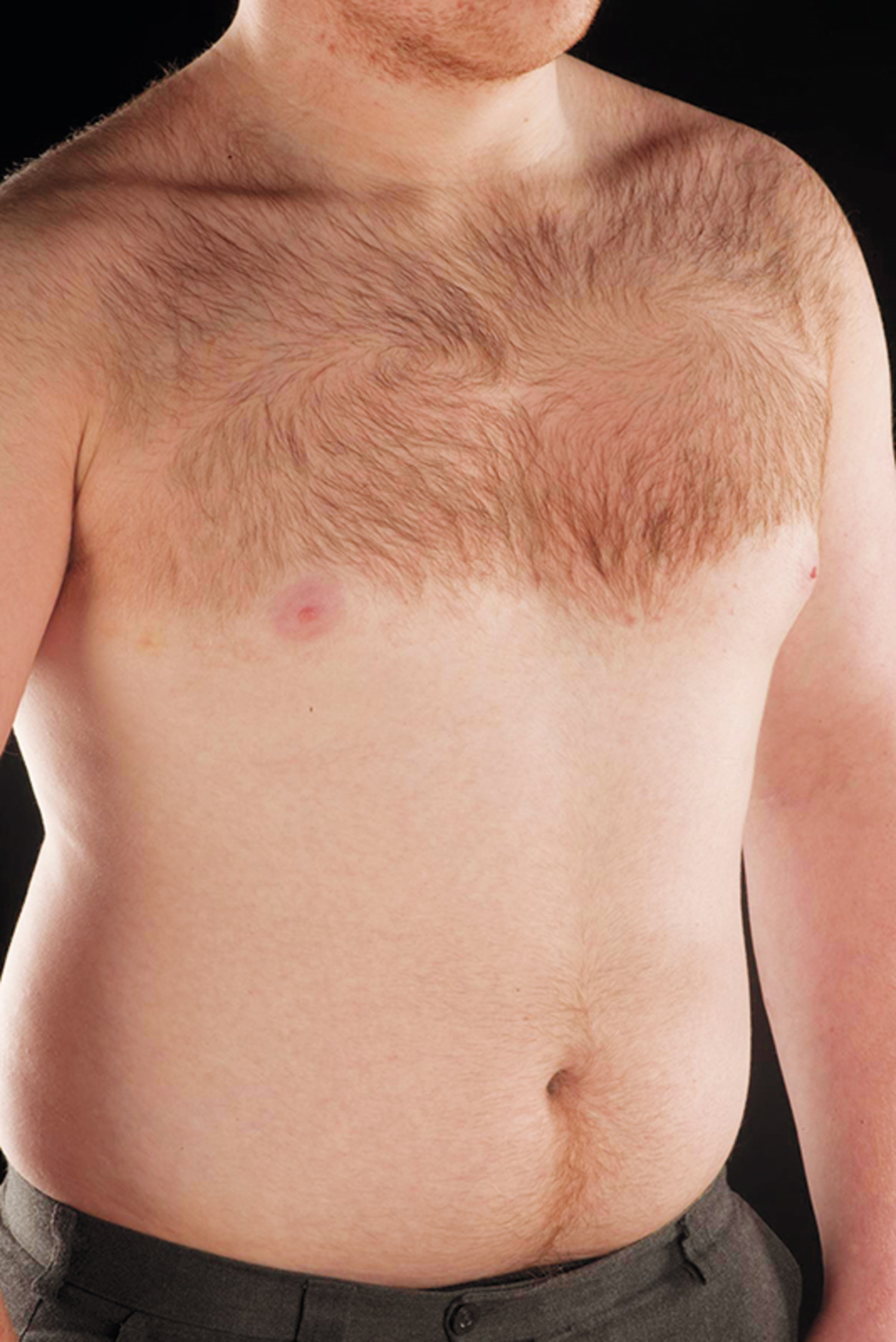 Becker's nevus