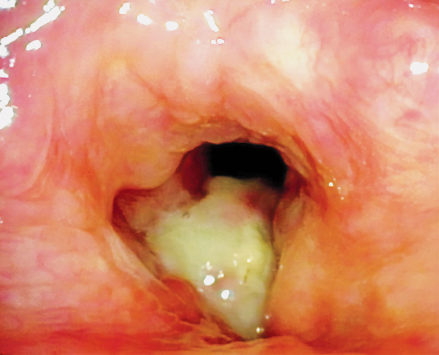 Carcinoma