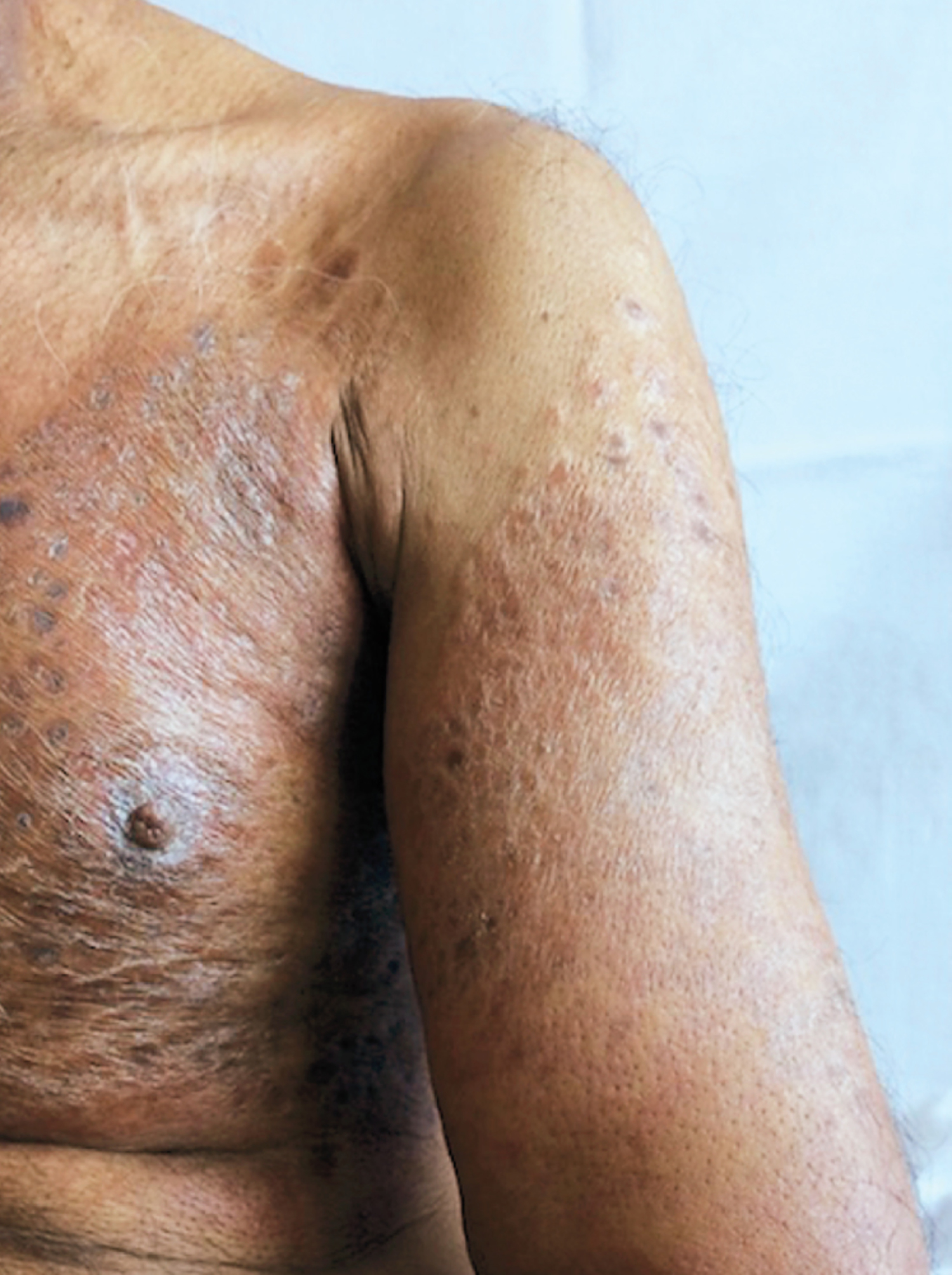 Carcinoma en cuirasse