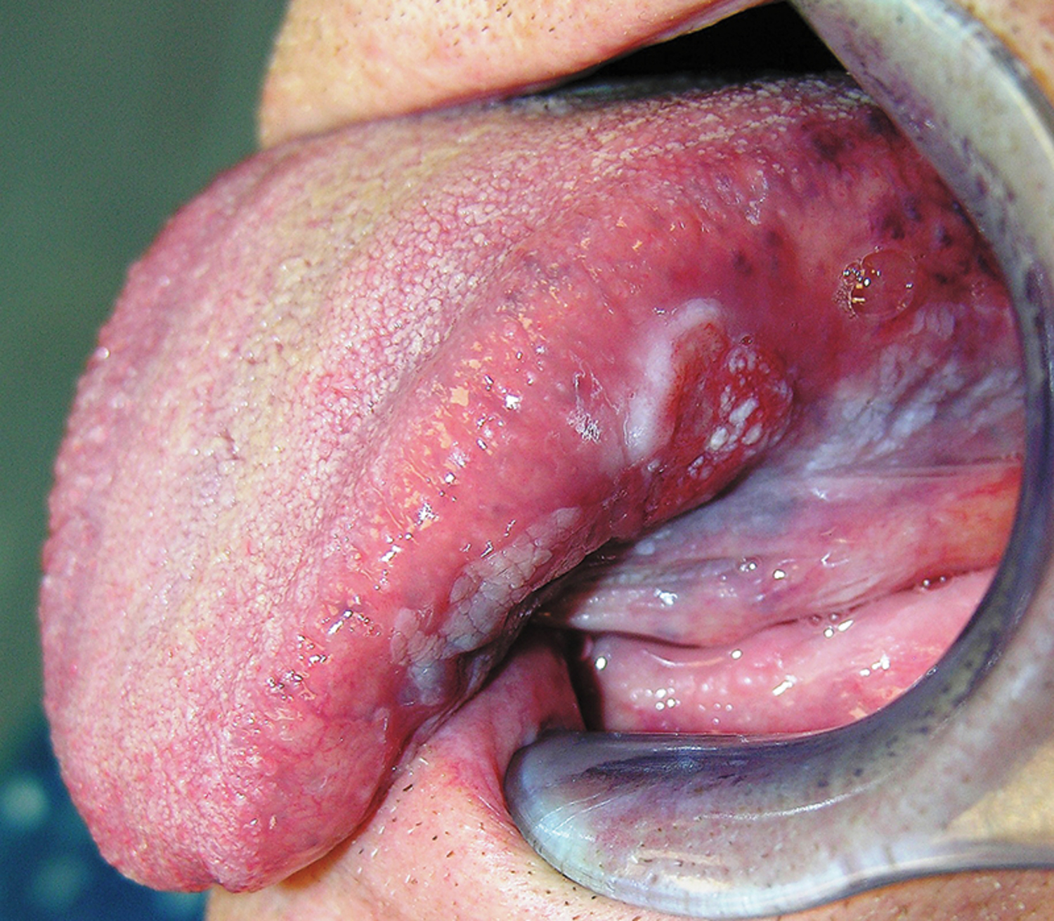 Squamous-cell carcinoma