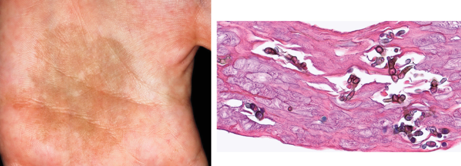 Tinea nigra