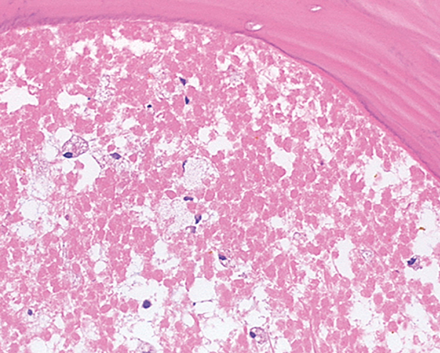 Bone marrow necrosis