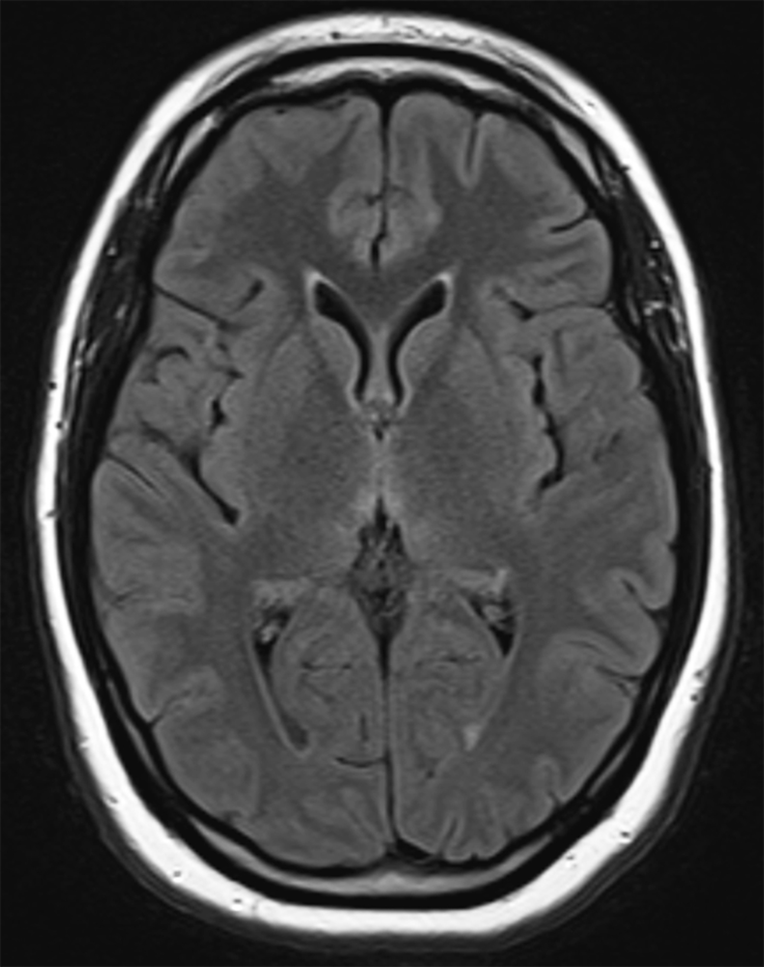 Wernicke's encephalopathy