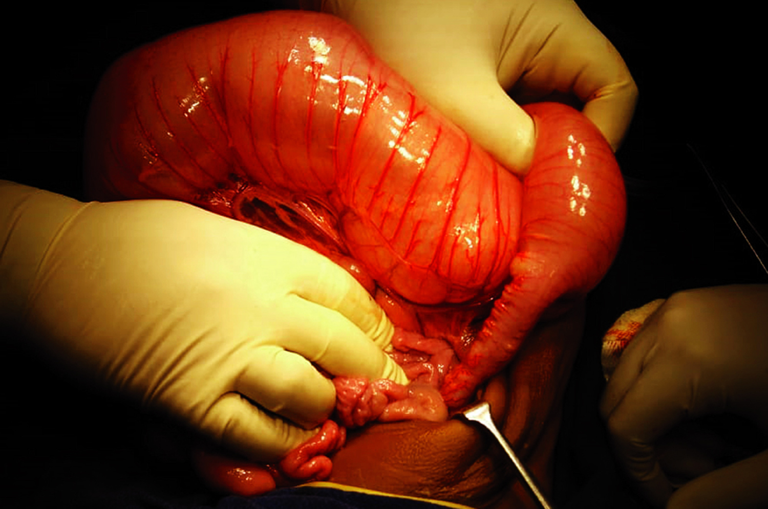 Hirschsprung's disease