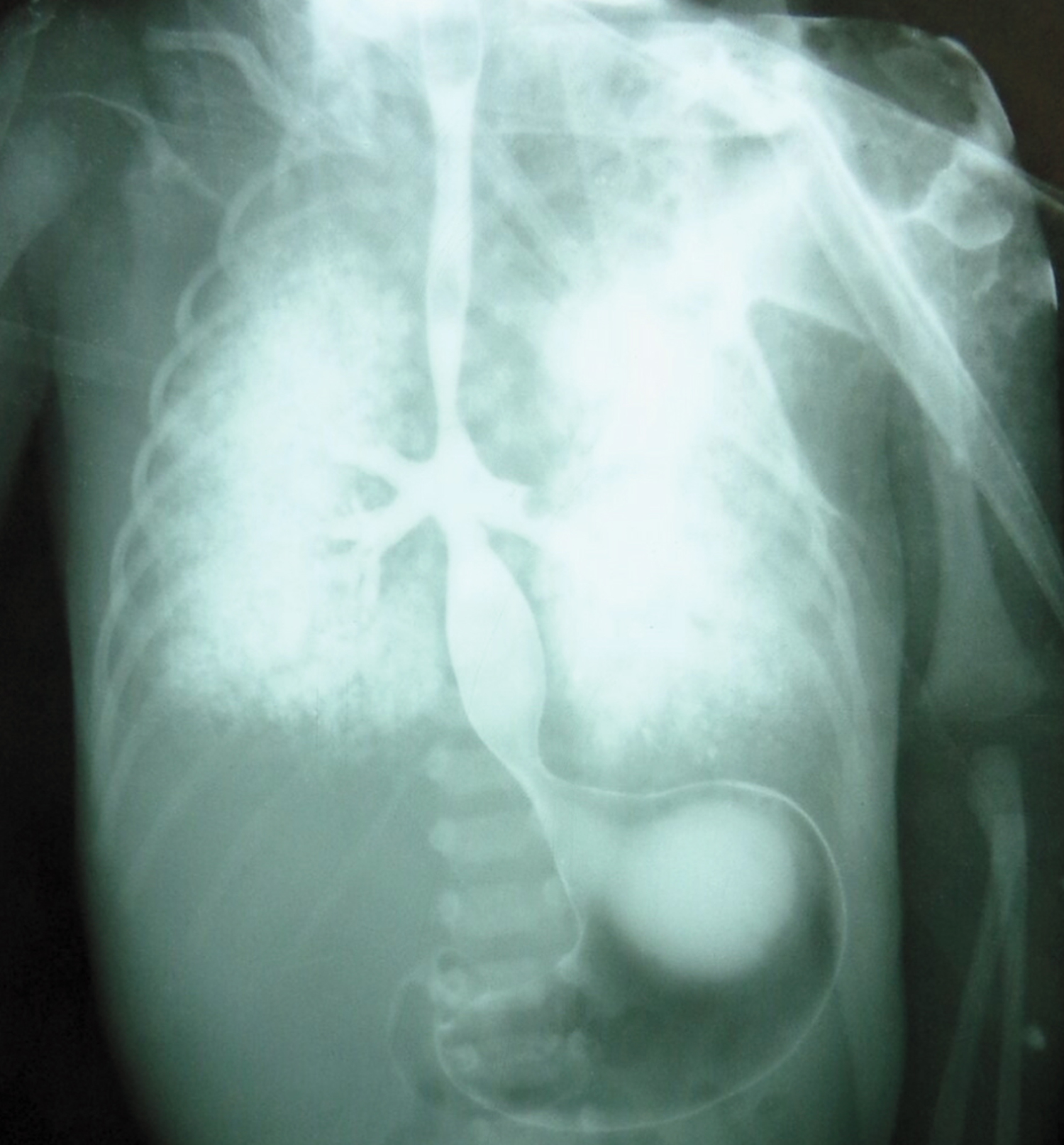 Tracheal agenesis with bronchoesophageal fistula