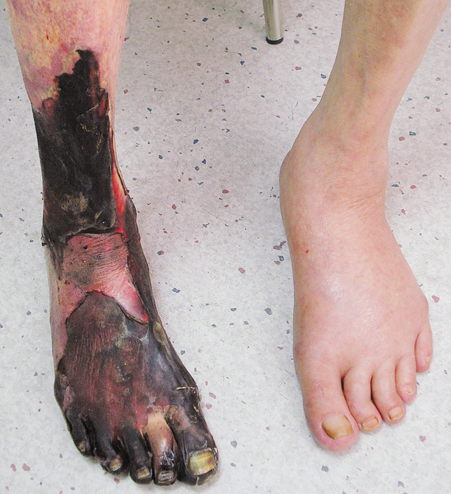Ischemic gangrene