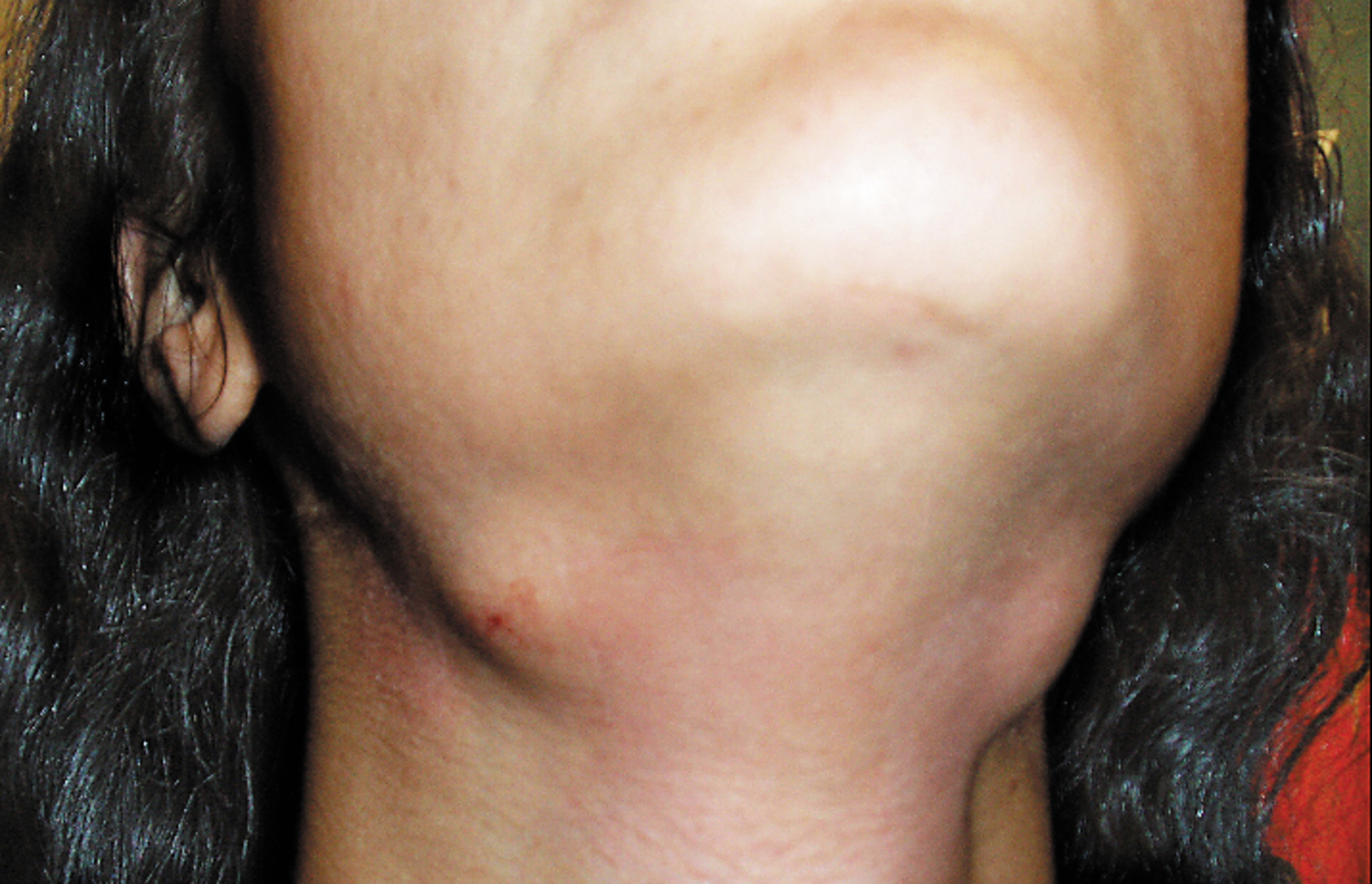 Sclerosing sialadenitis