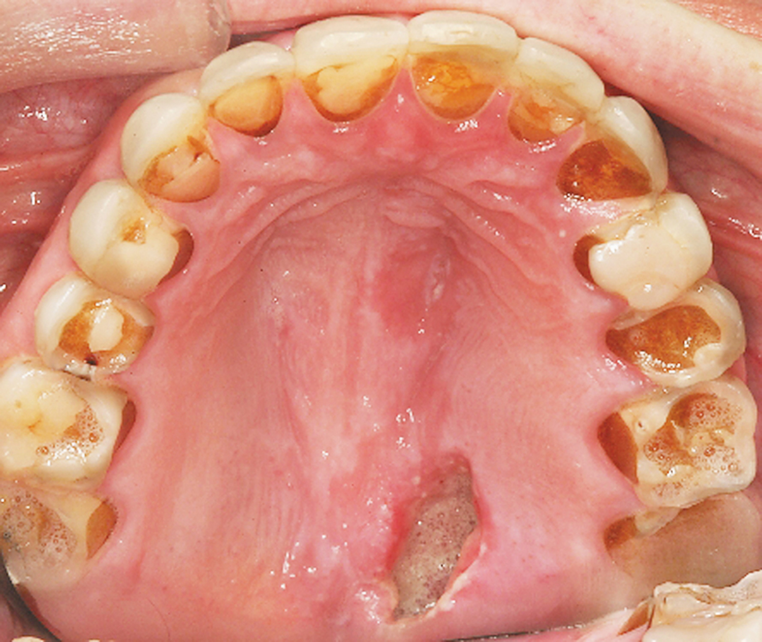 Bulimia nervosa