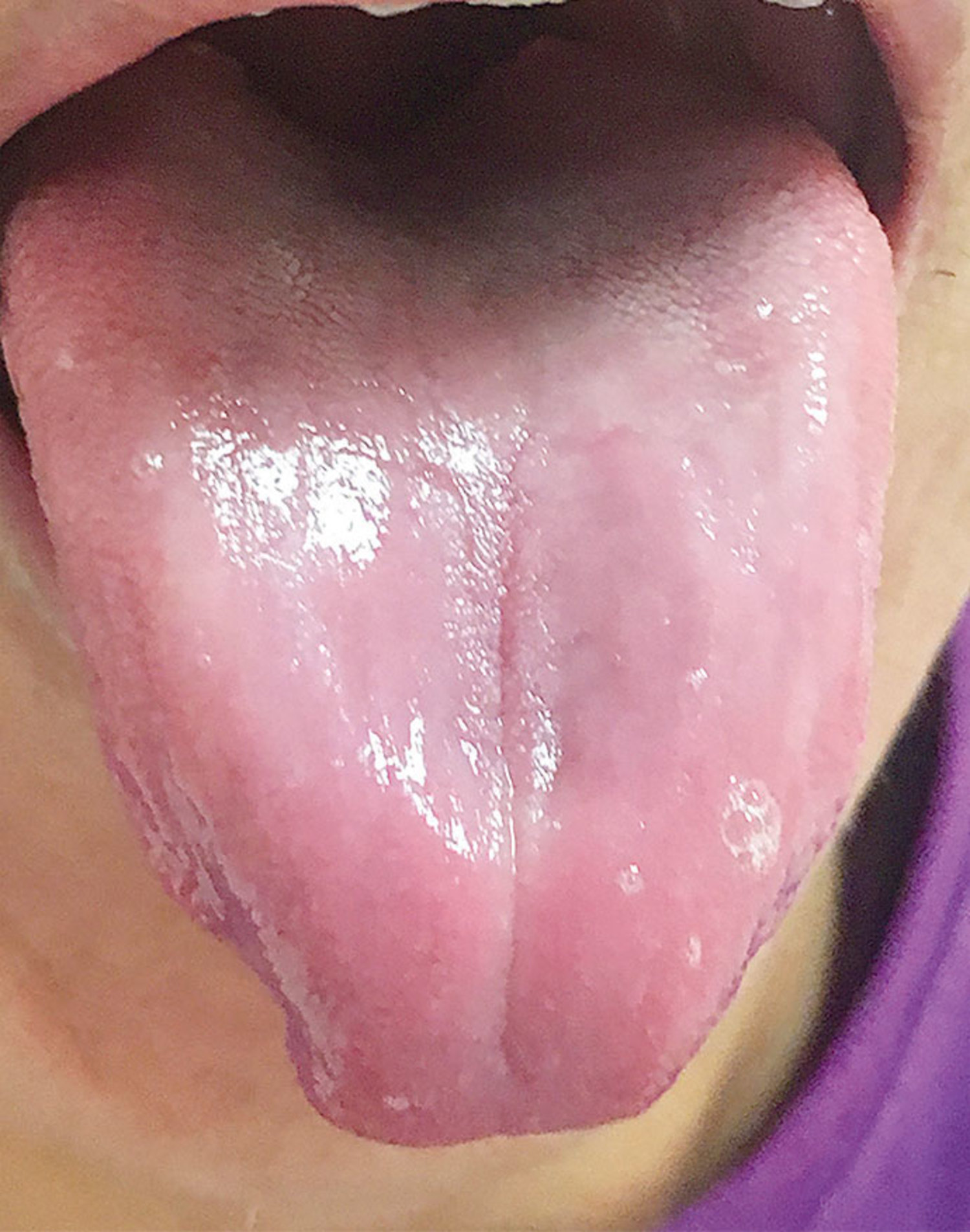Pernicious anemia