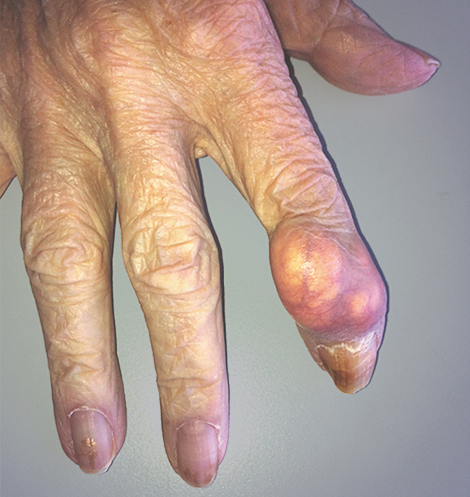 Tophaceous gout