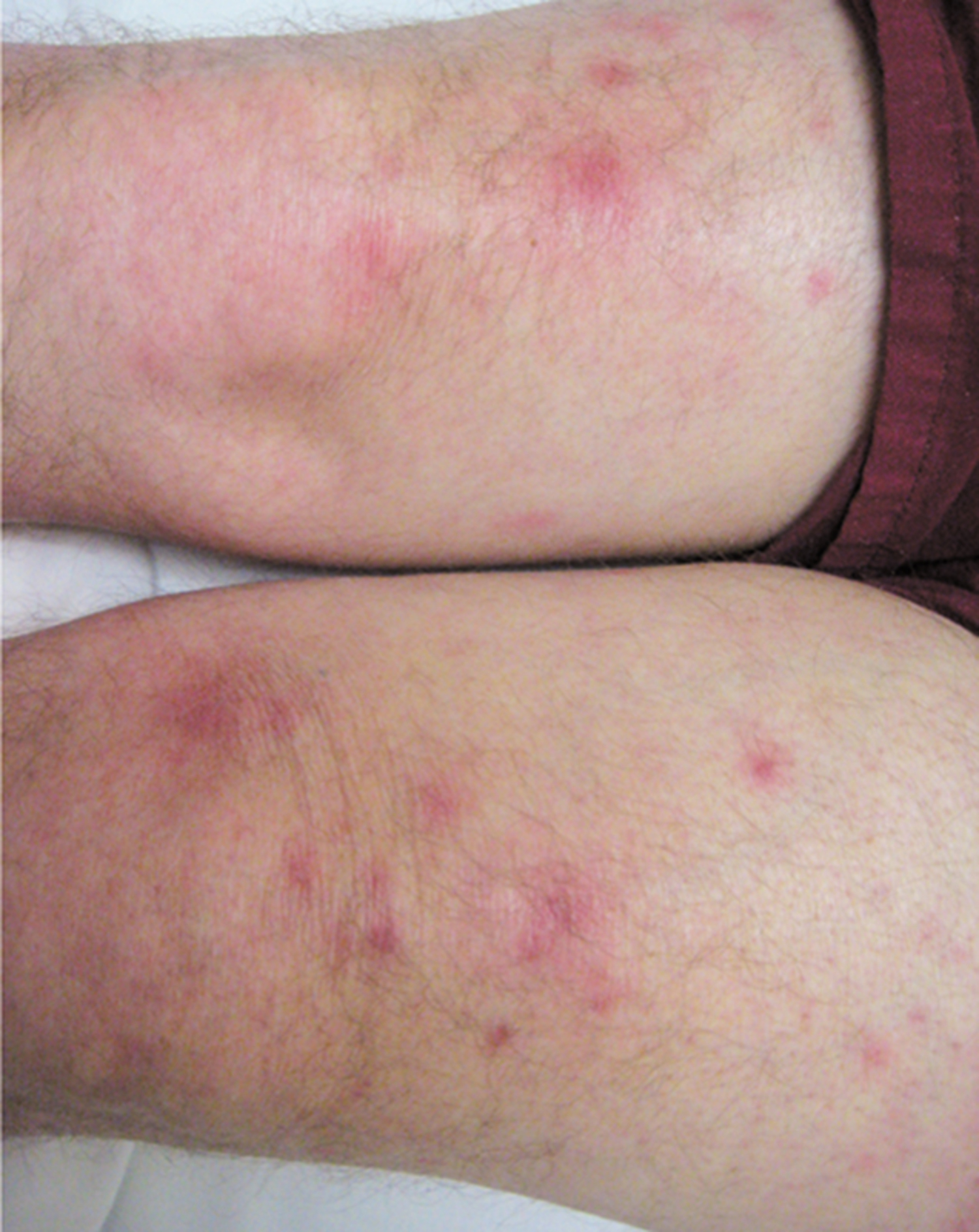 Panniculitis