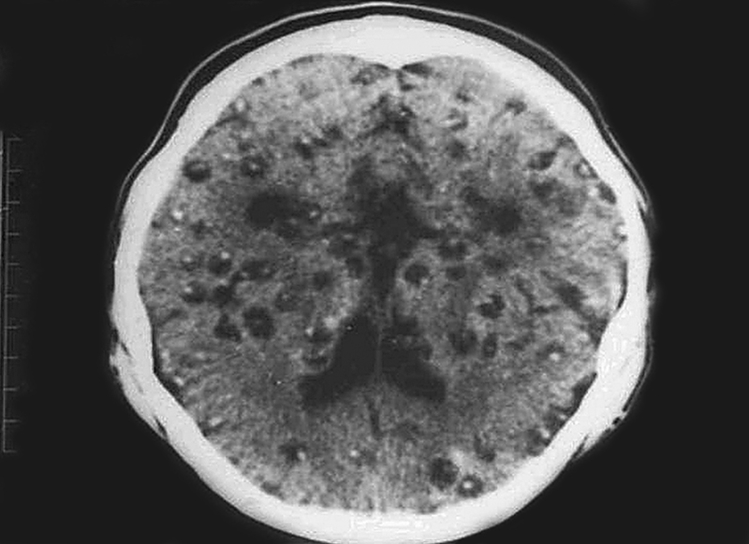 Neurocysticercosis