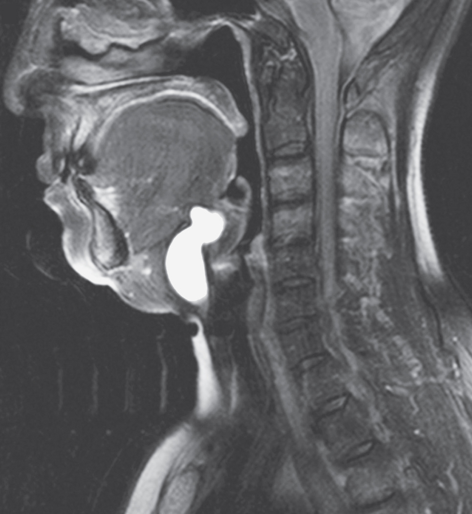 Thyroglossal duct cyst