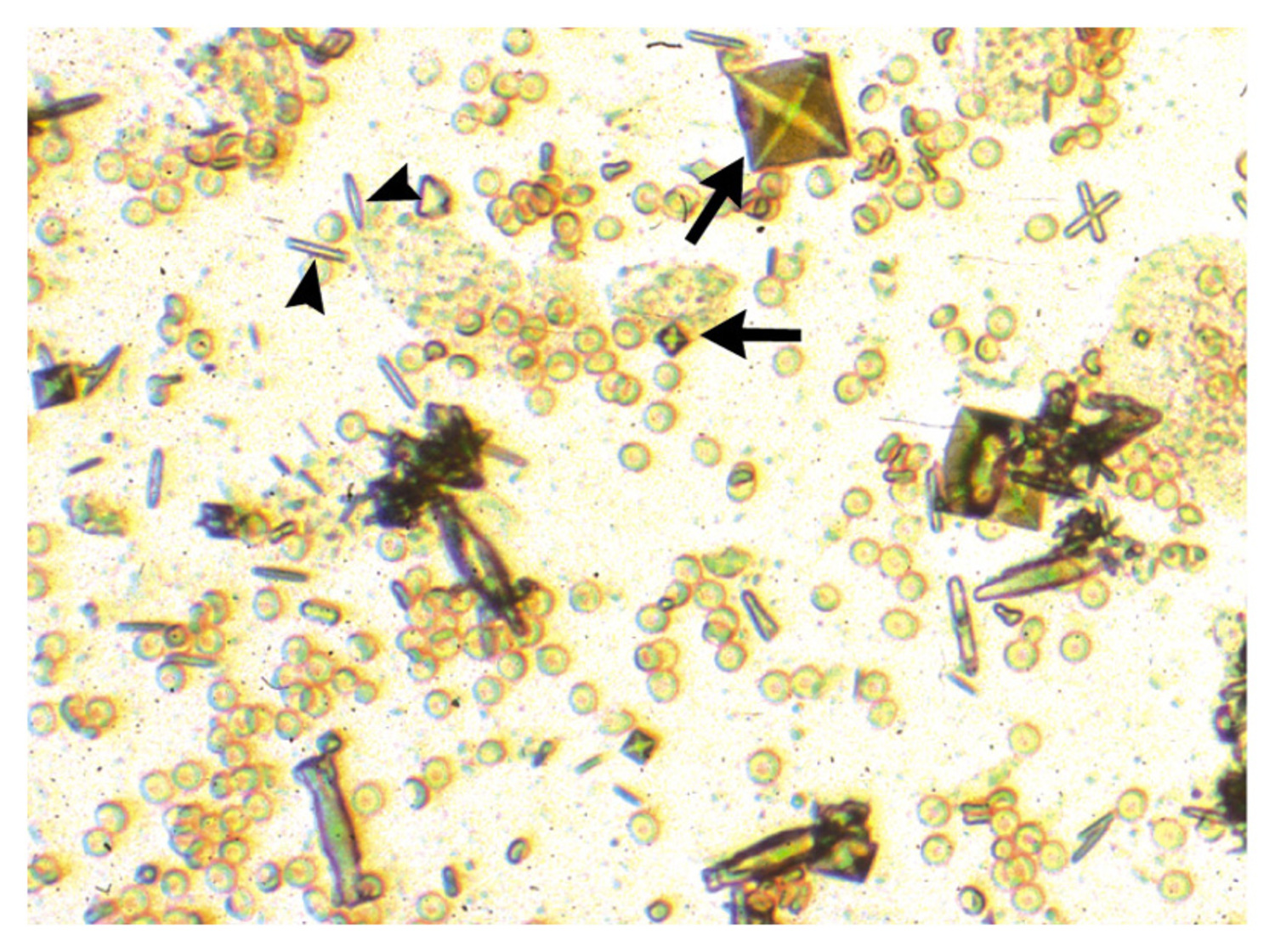 Ethylene glycol poisoning