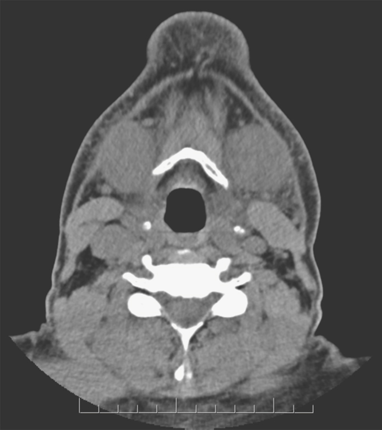 Iodide-associated sialadenitis