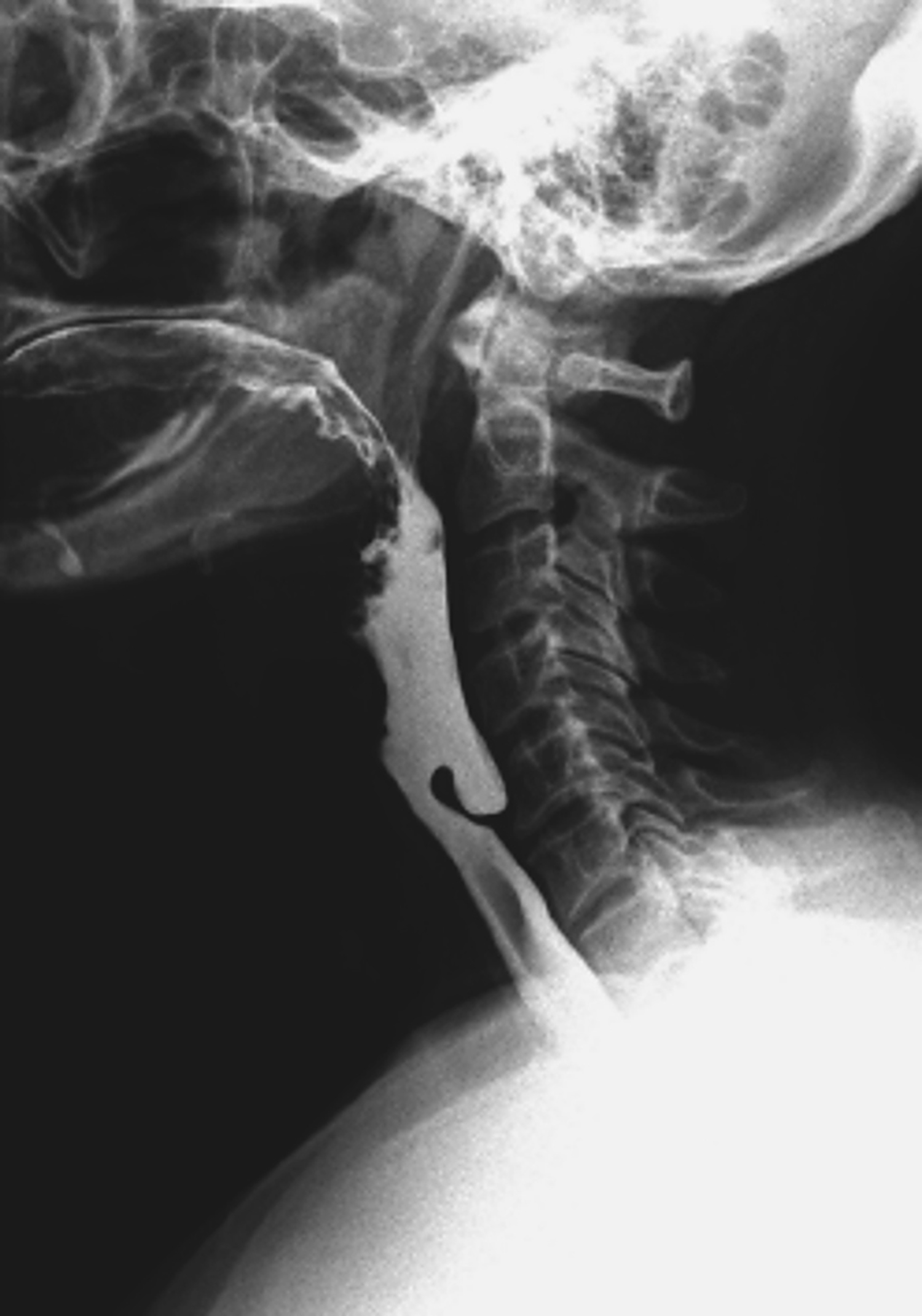Zenker's diverticulum