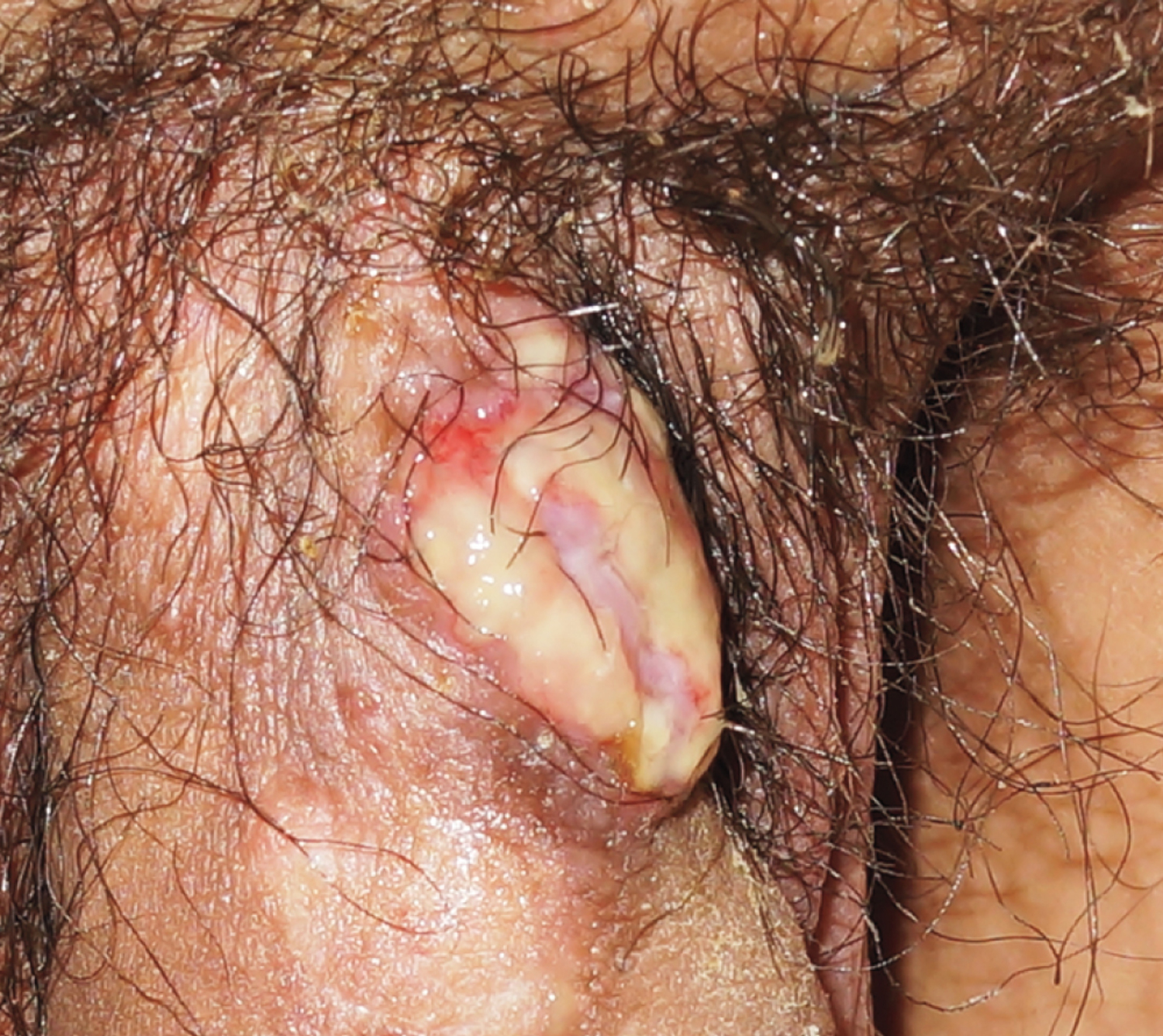 Herpes vegetans