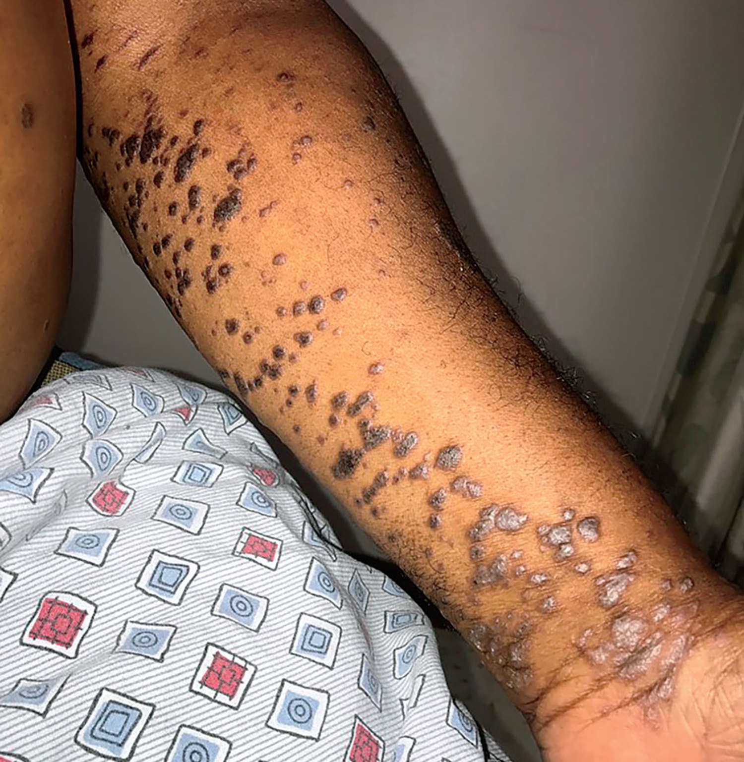 Lichen planus