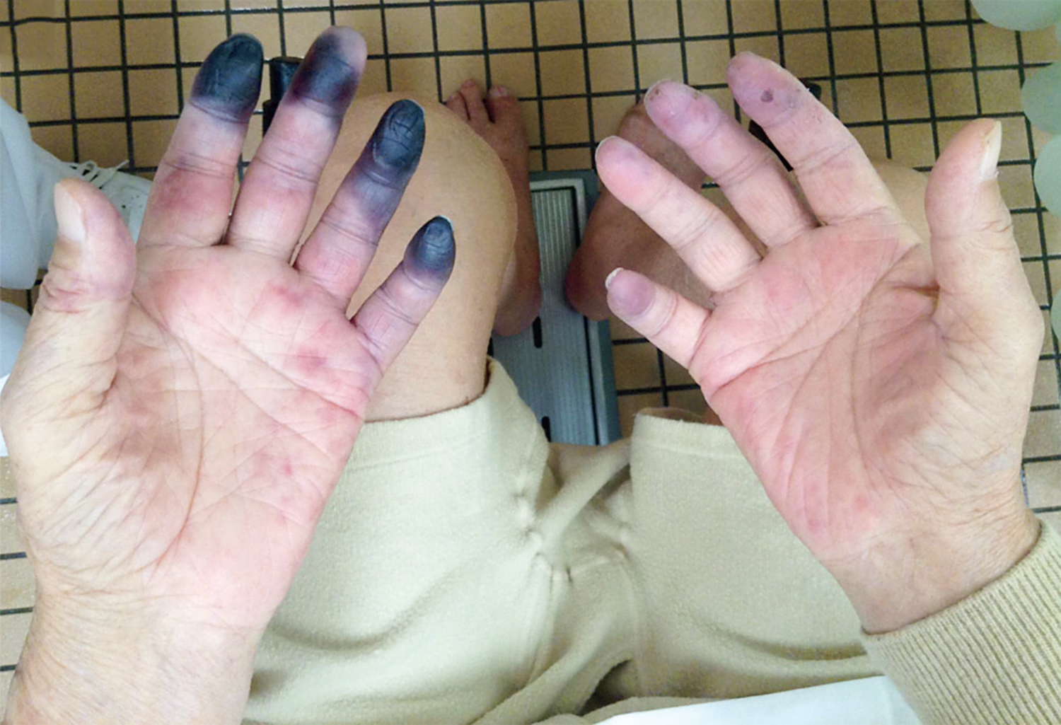 Polyarteritis nodosa