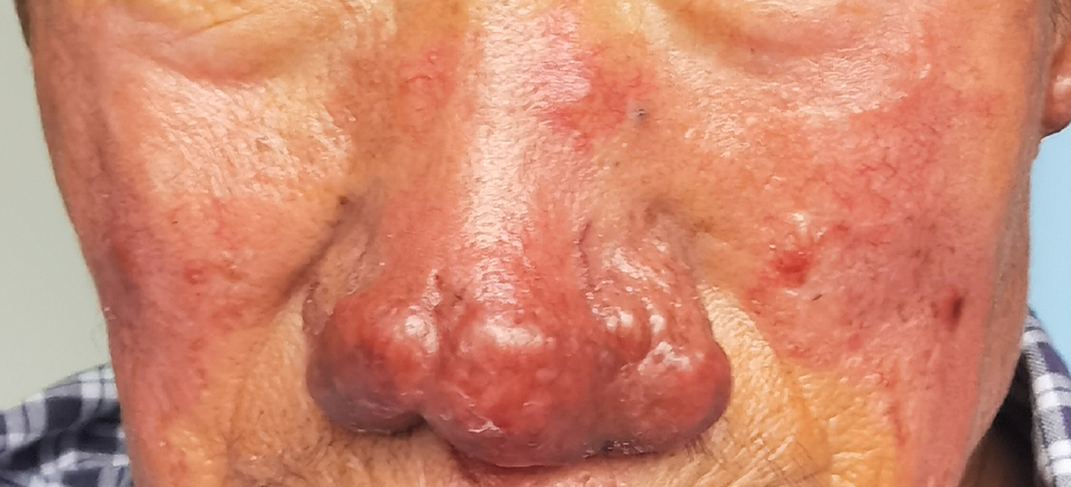Lupus pernio
