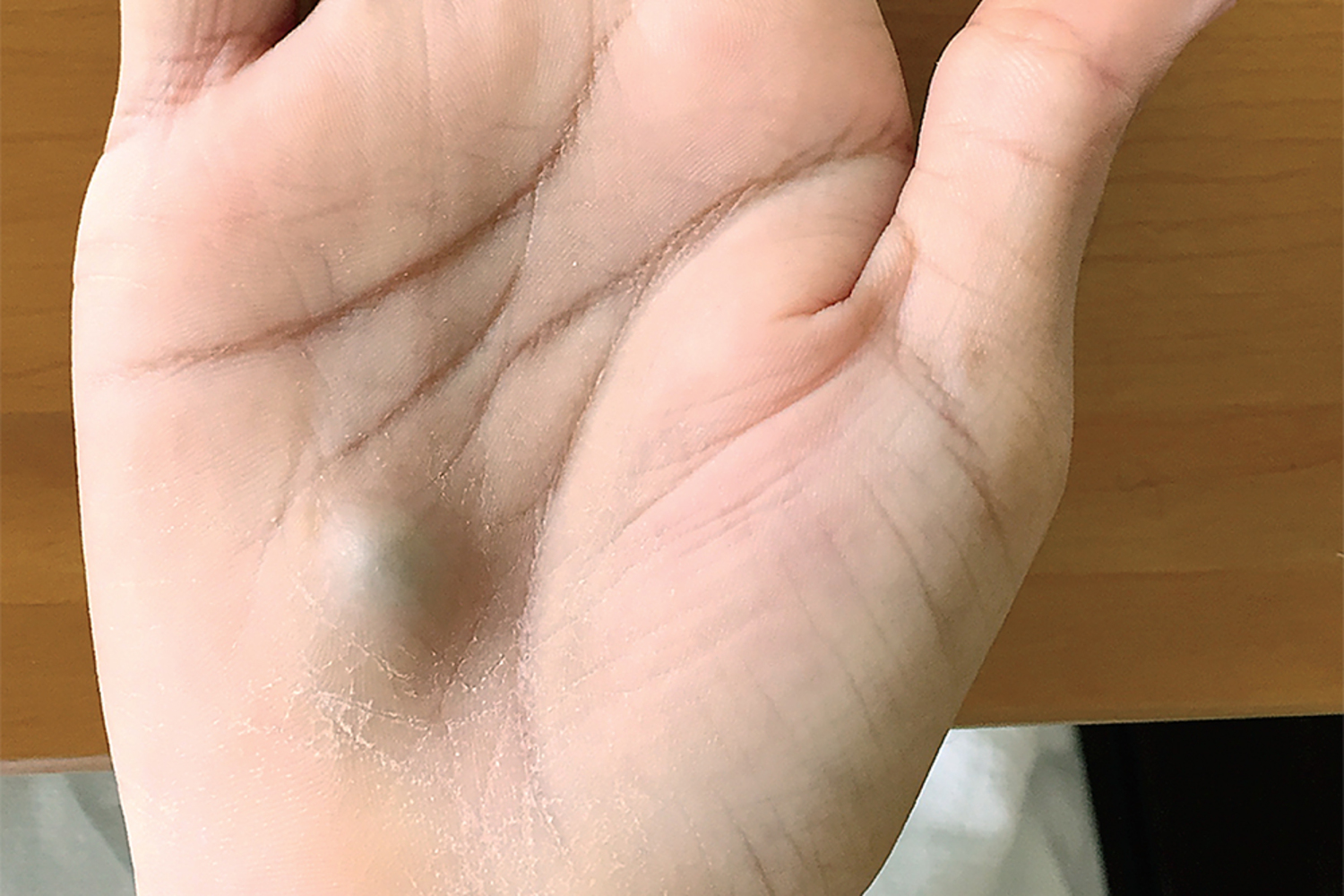 Infective endocarditis