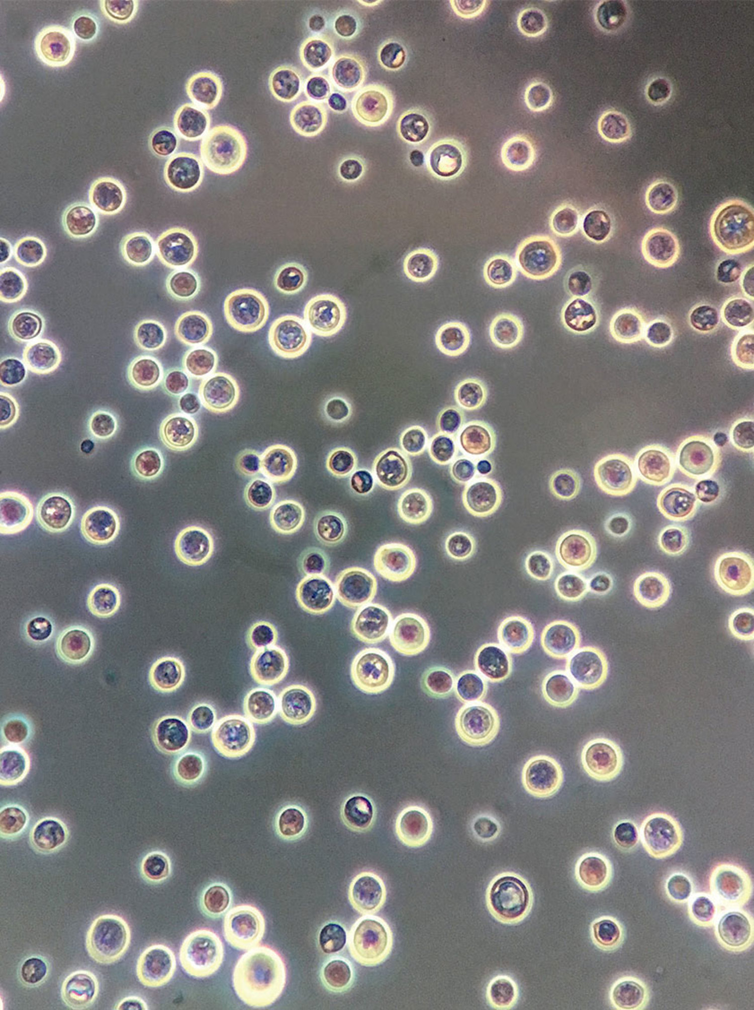 Cryptococcal meningitis