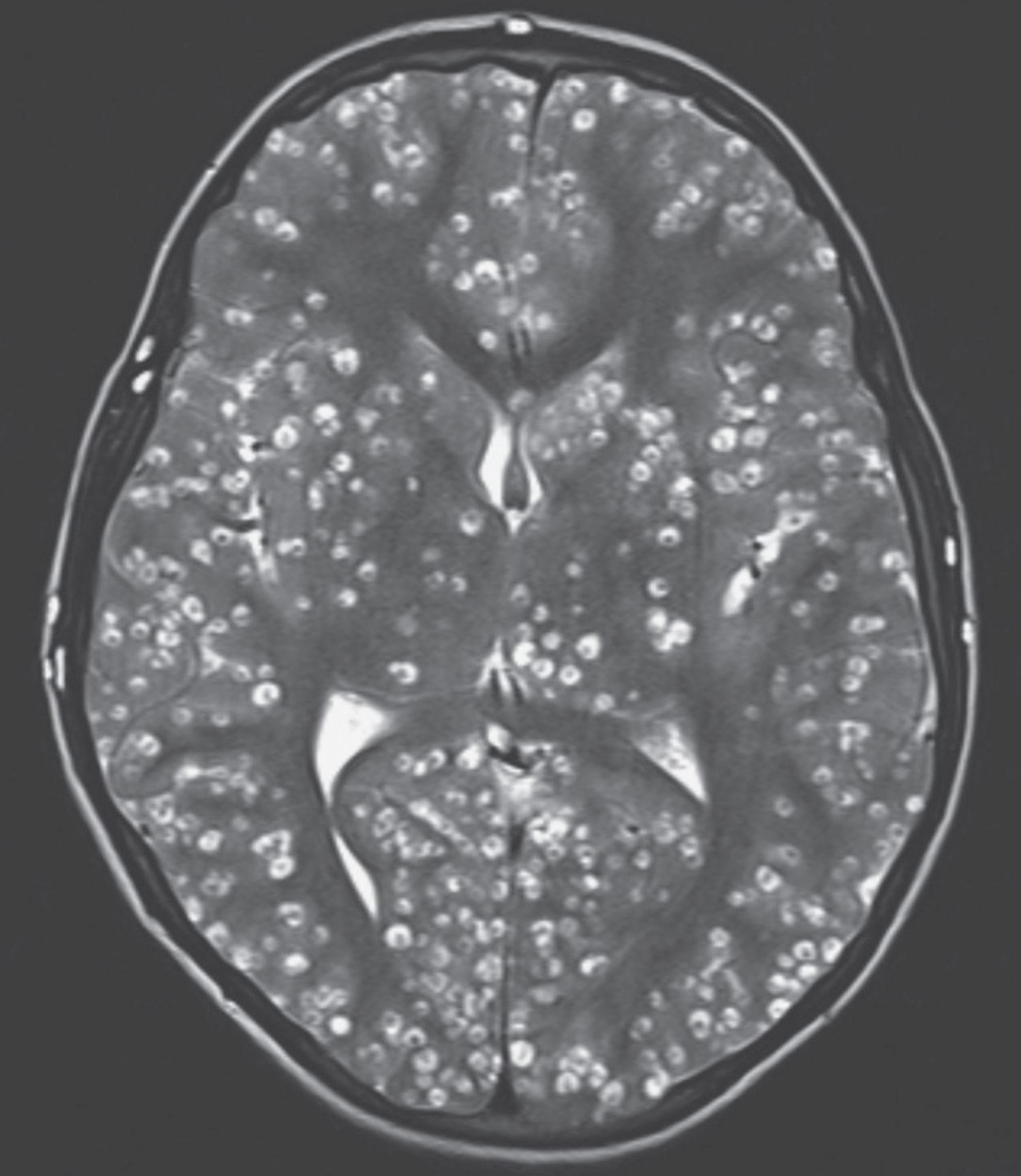 Neurocysticercosis