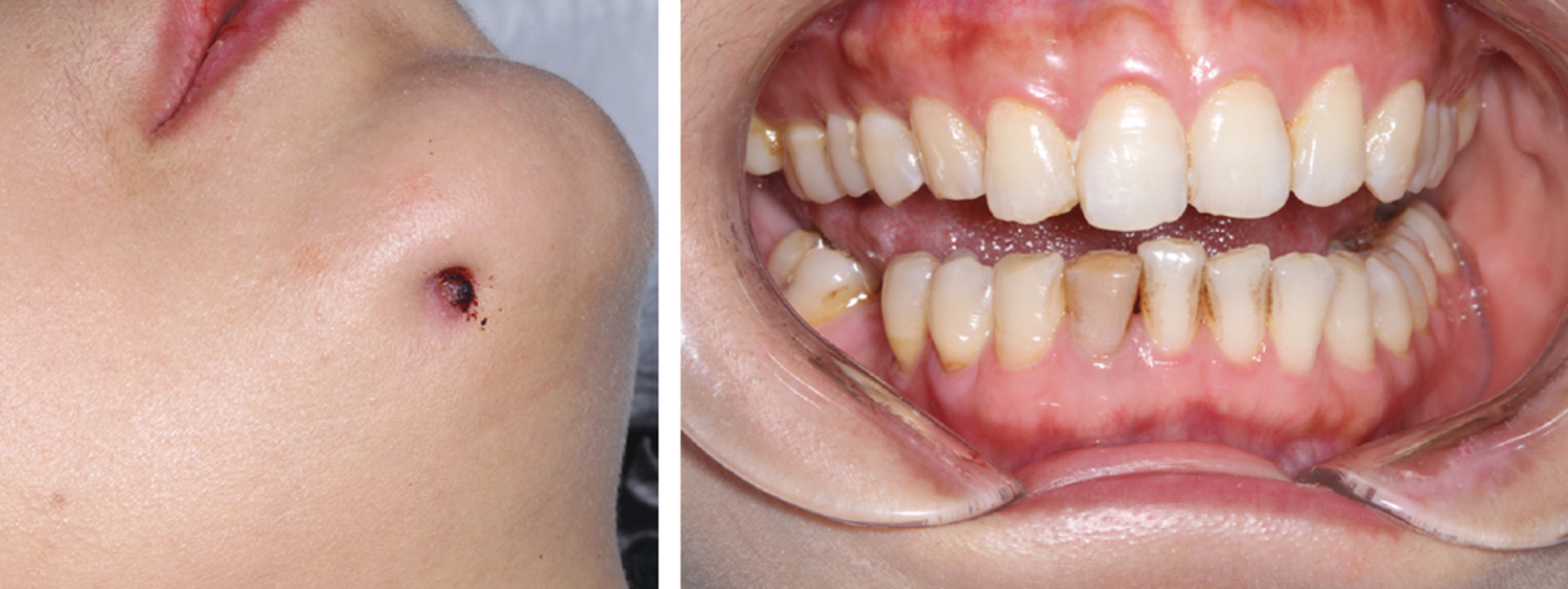 Odontogenic cutaneous fistula