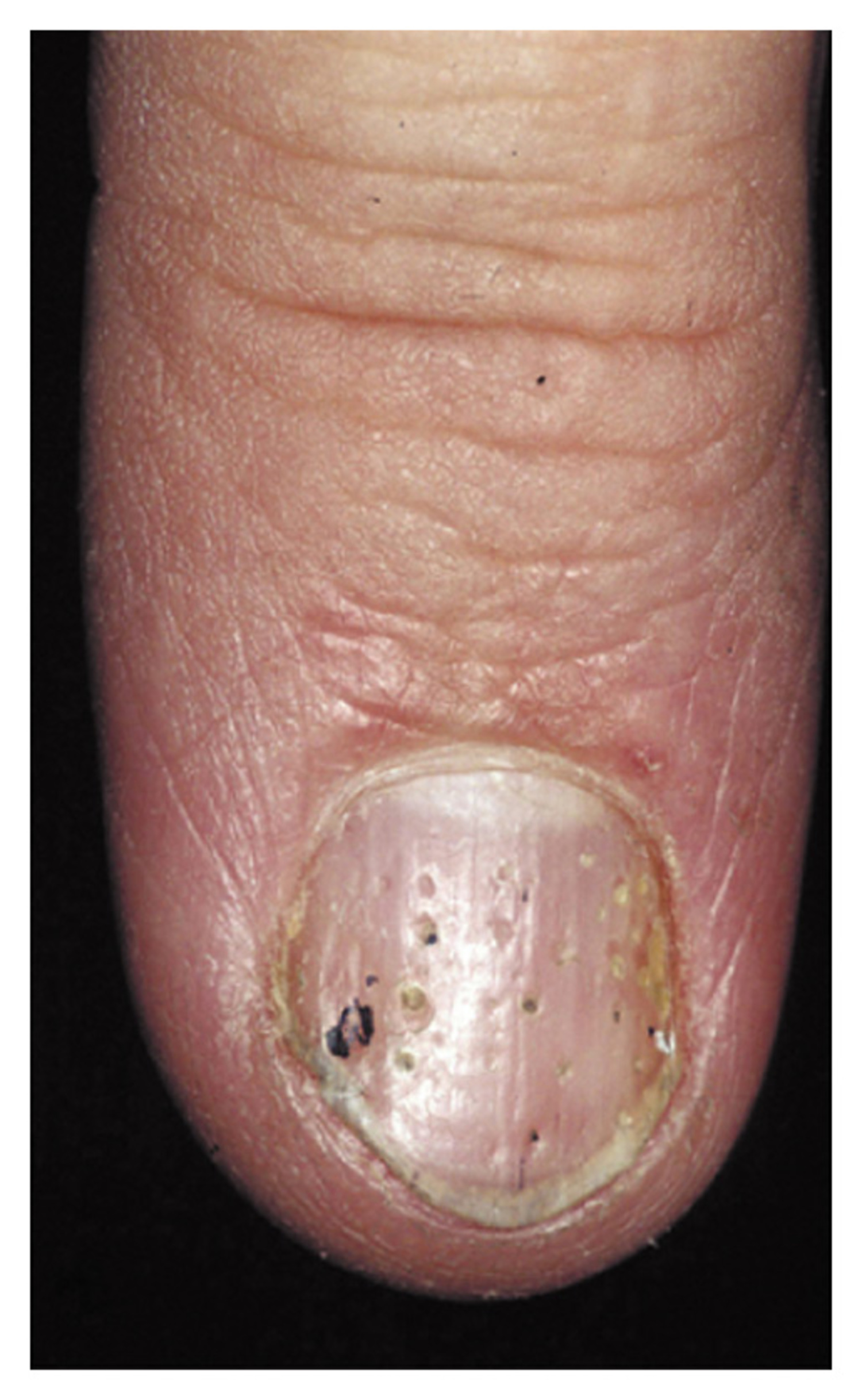 Psoriasis