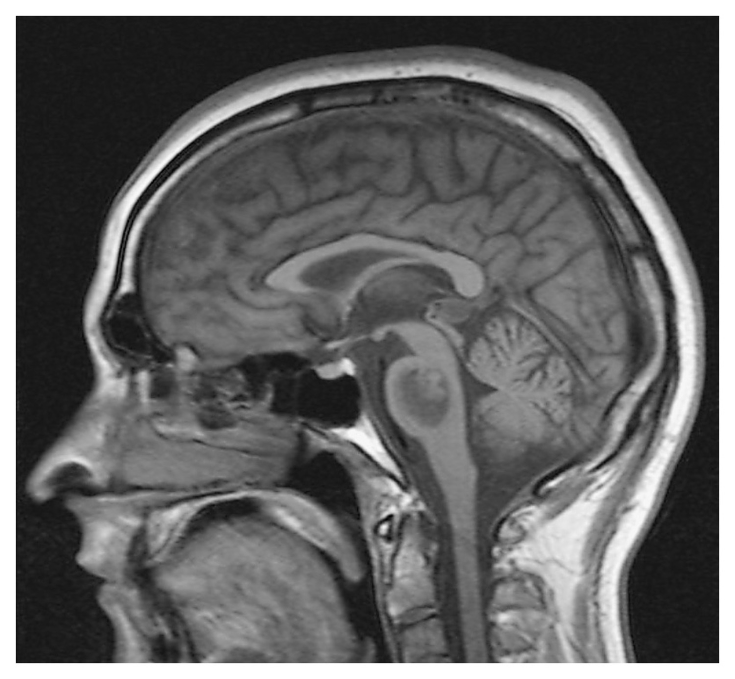 Central pontine myelinolysis
